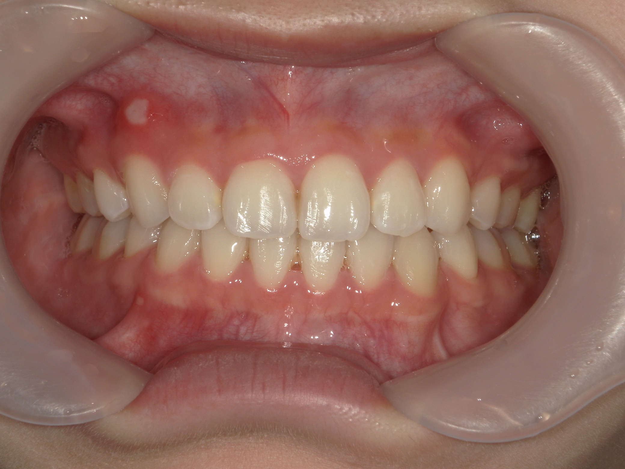 全顎ワイヤー矯正　症例（85）