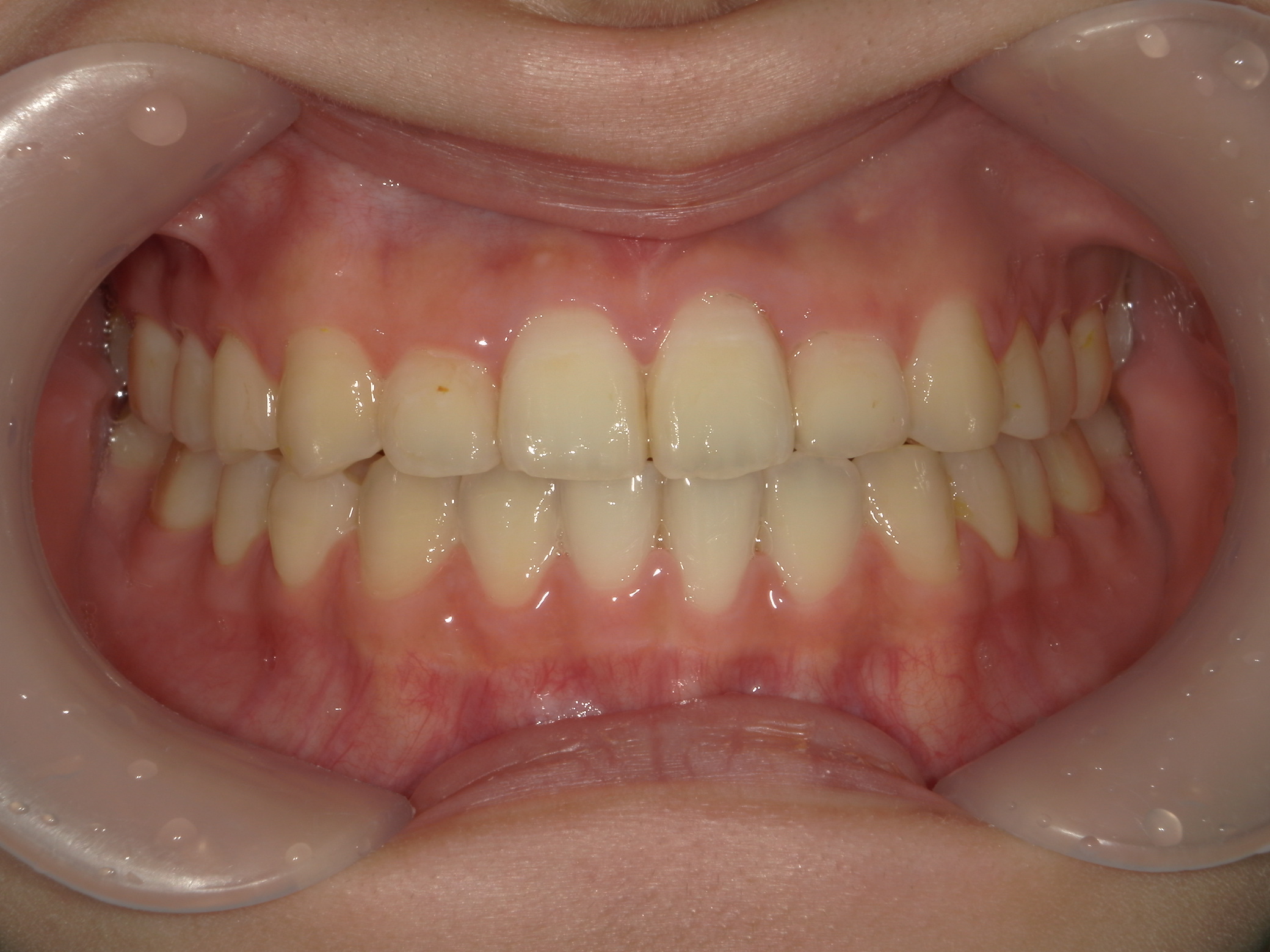プチワイヤー矯正　症例（66）