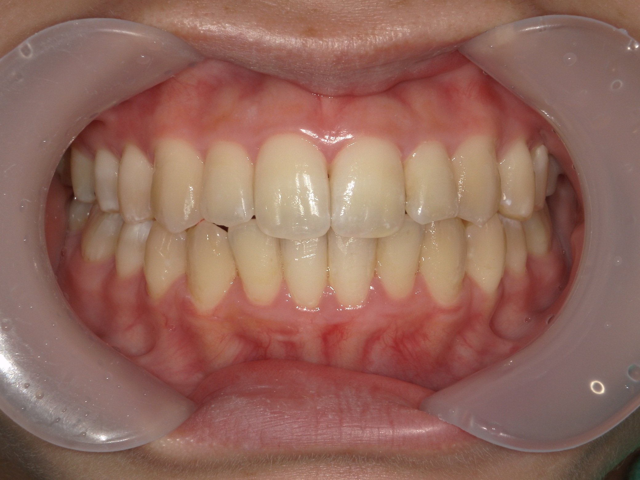 インビザライン(ライト)矯正　症例（35）