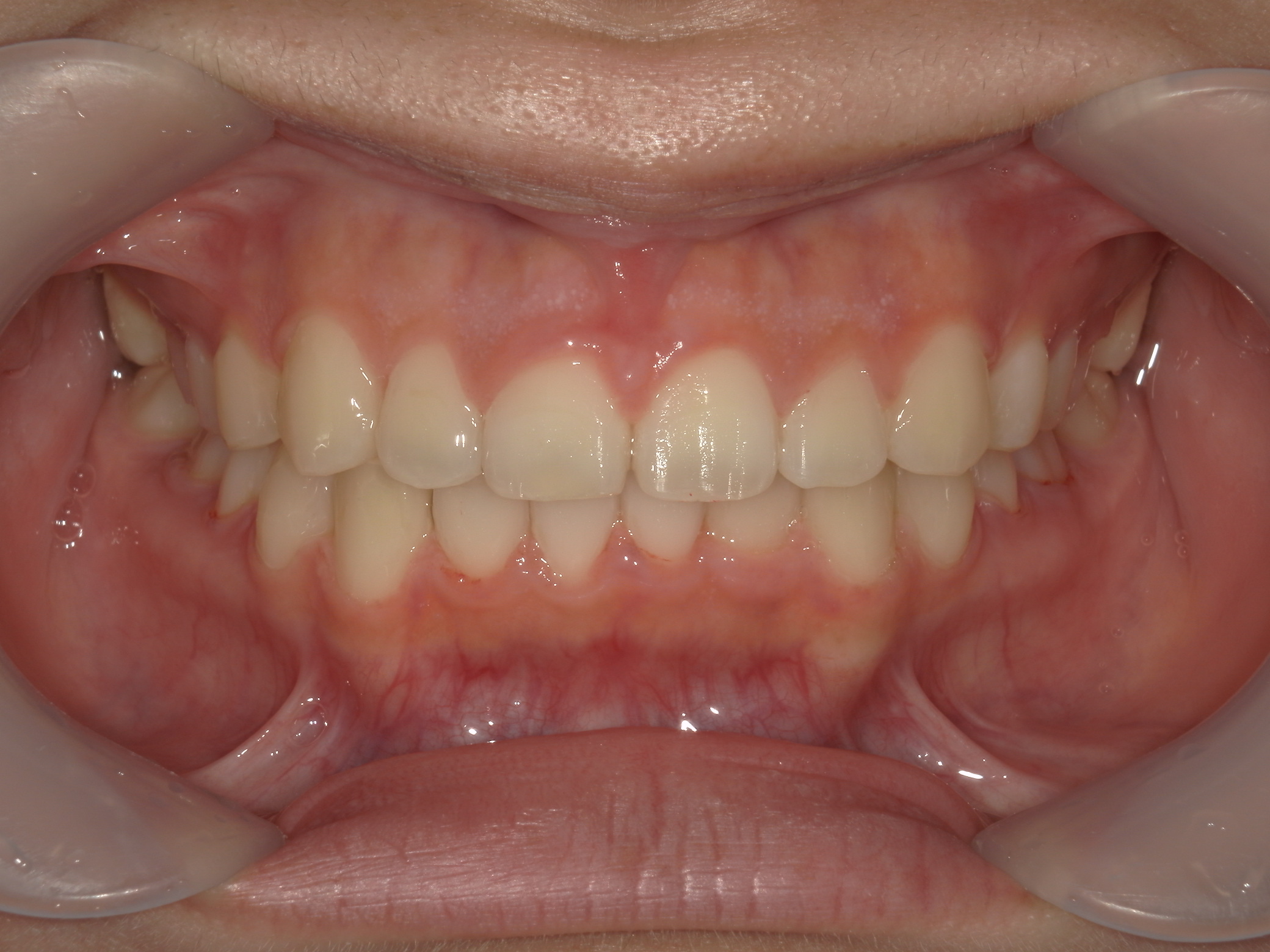 プチワイヤー矯正　症例（64）