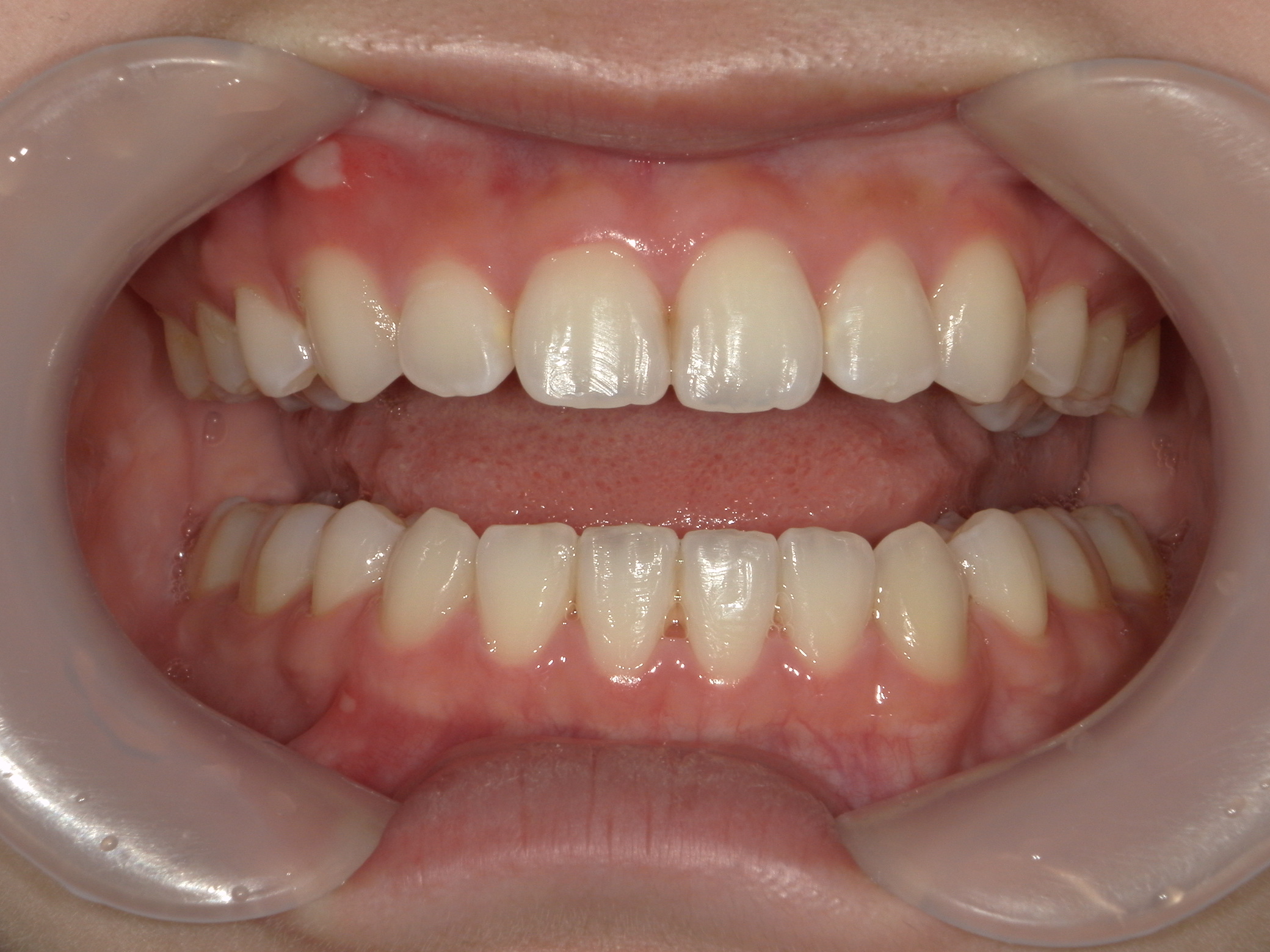 全顎ワイヤー矯正　症例（85）