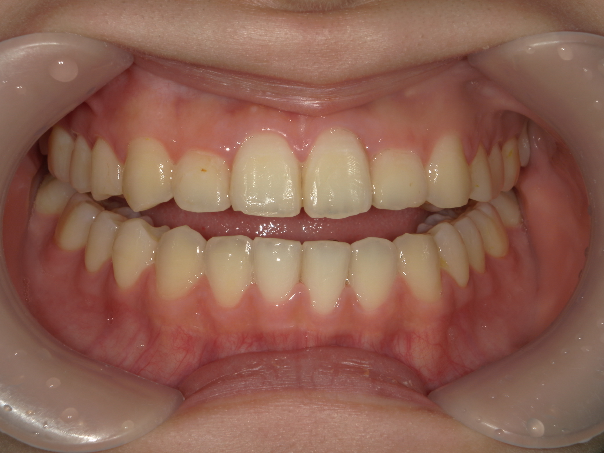 プチワイヤー矯正　症例（66）