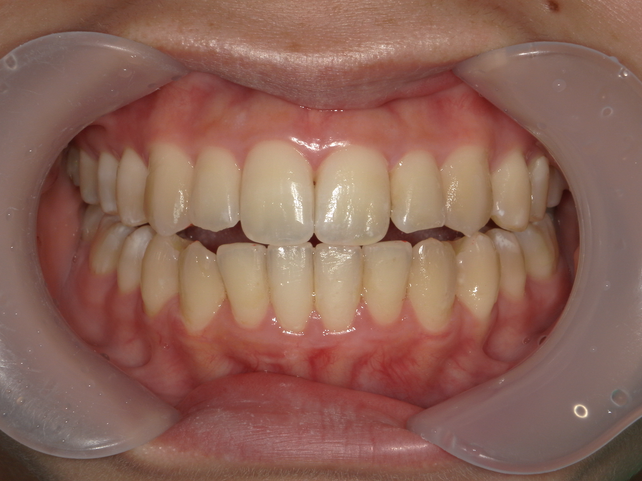 インビザライン(ライト)矯正　症例（35）