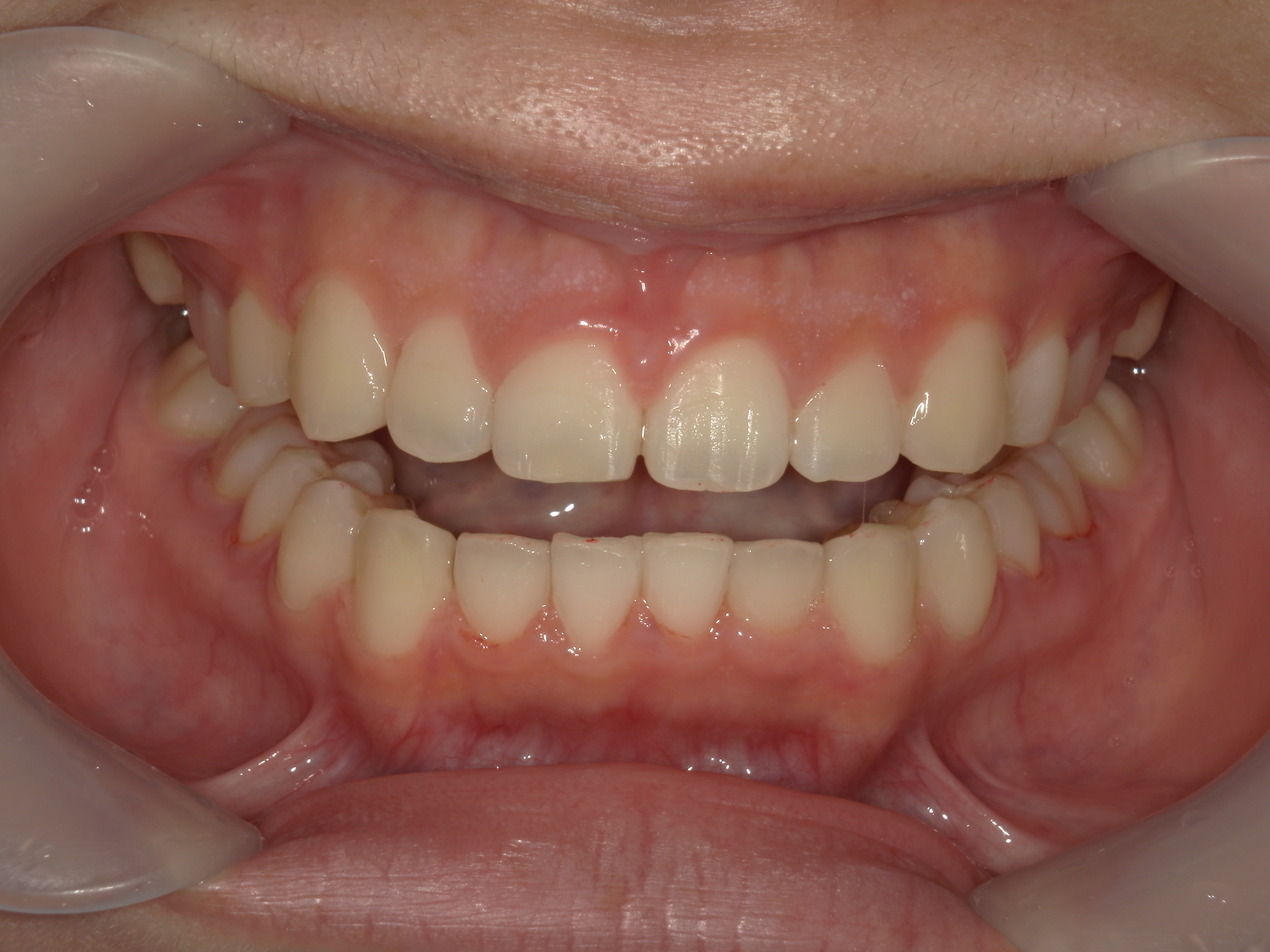 プチワイヤー矯正　症例（64）