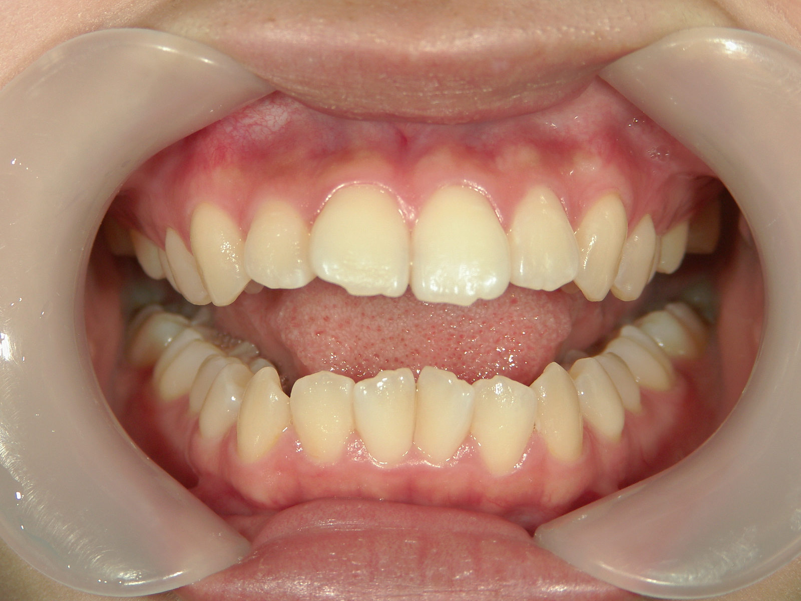 全顎ワイヤー矯正　症例（85）