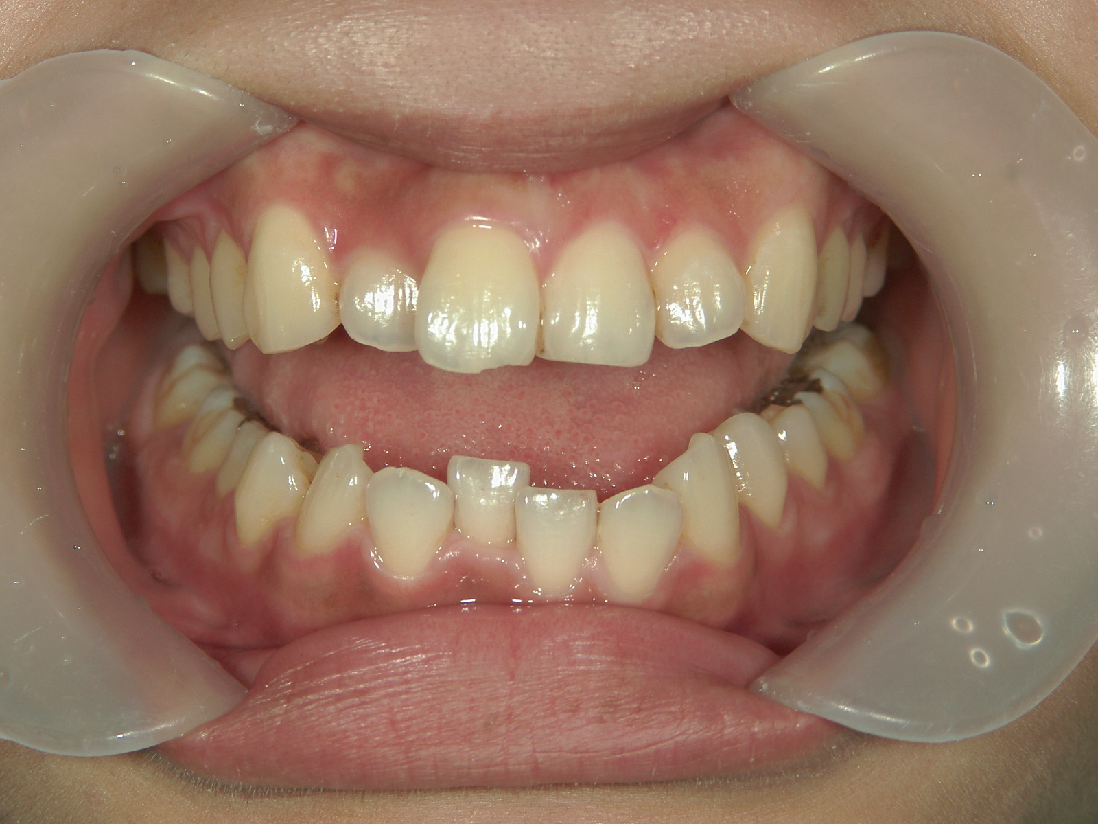 プチワイヤー矯正　症例（65）