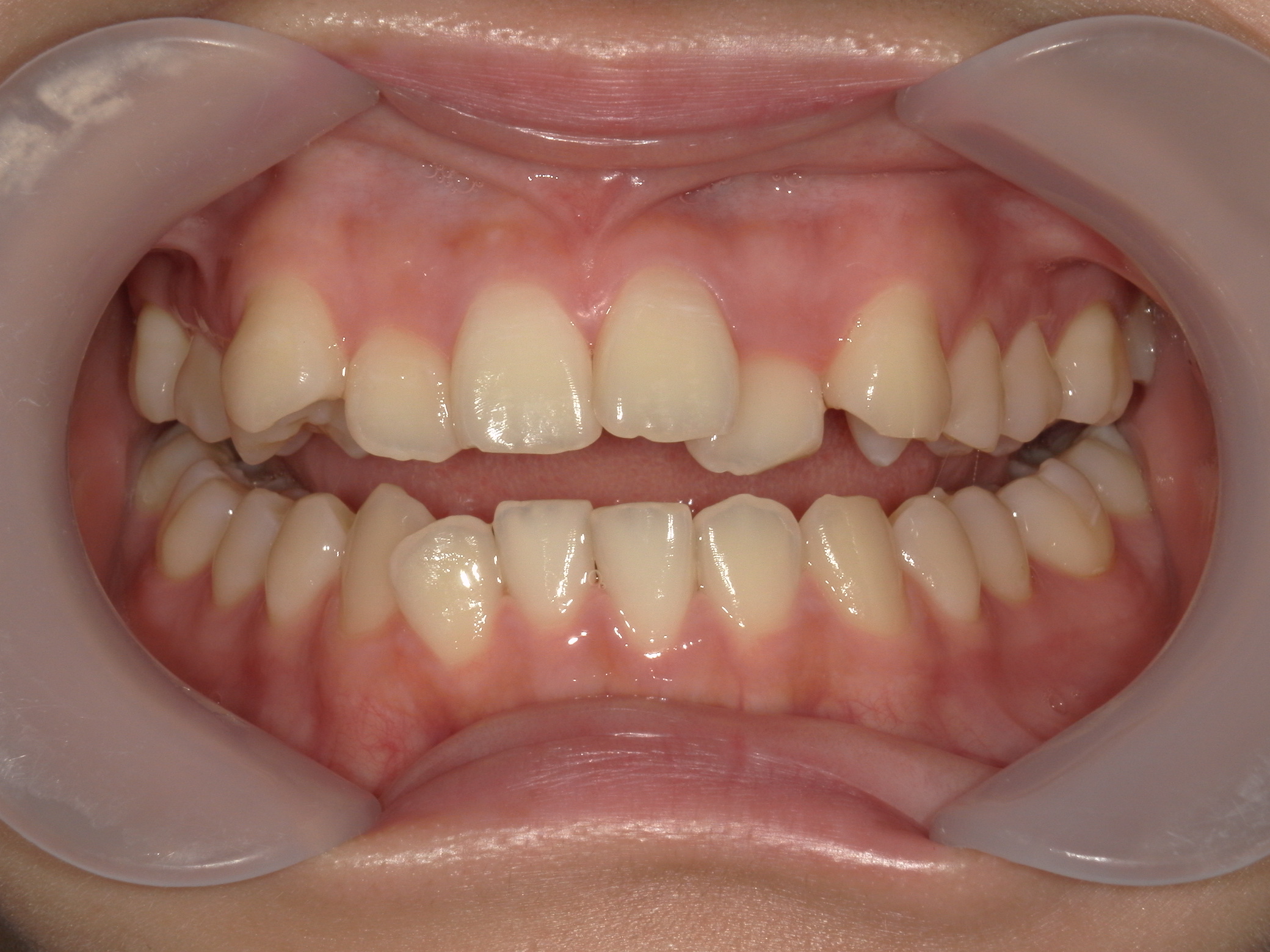 プチワイヤー矯正　症例（66）