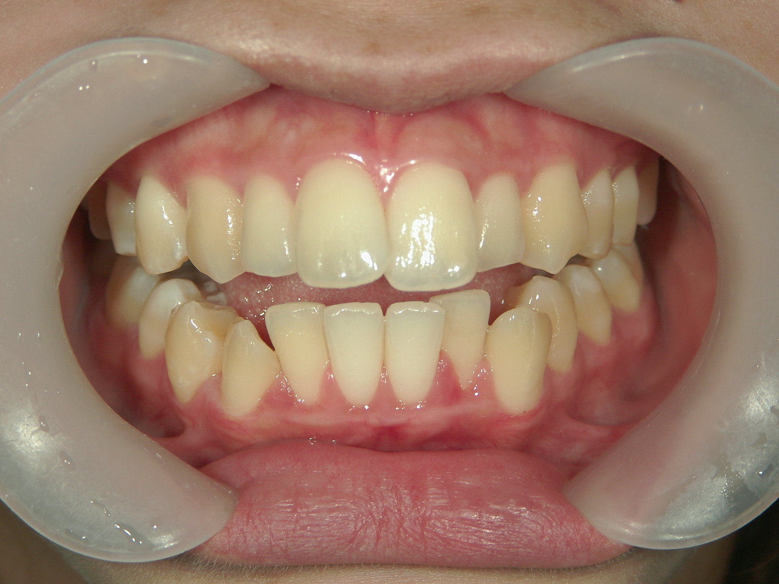 インビザライン(ライト)矯正　症例（35）