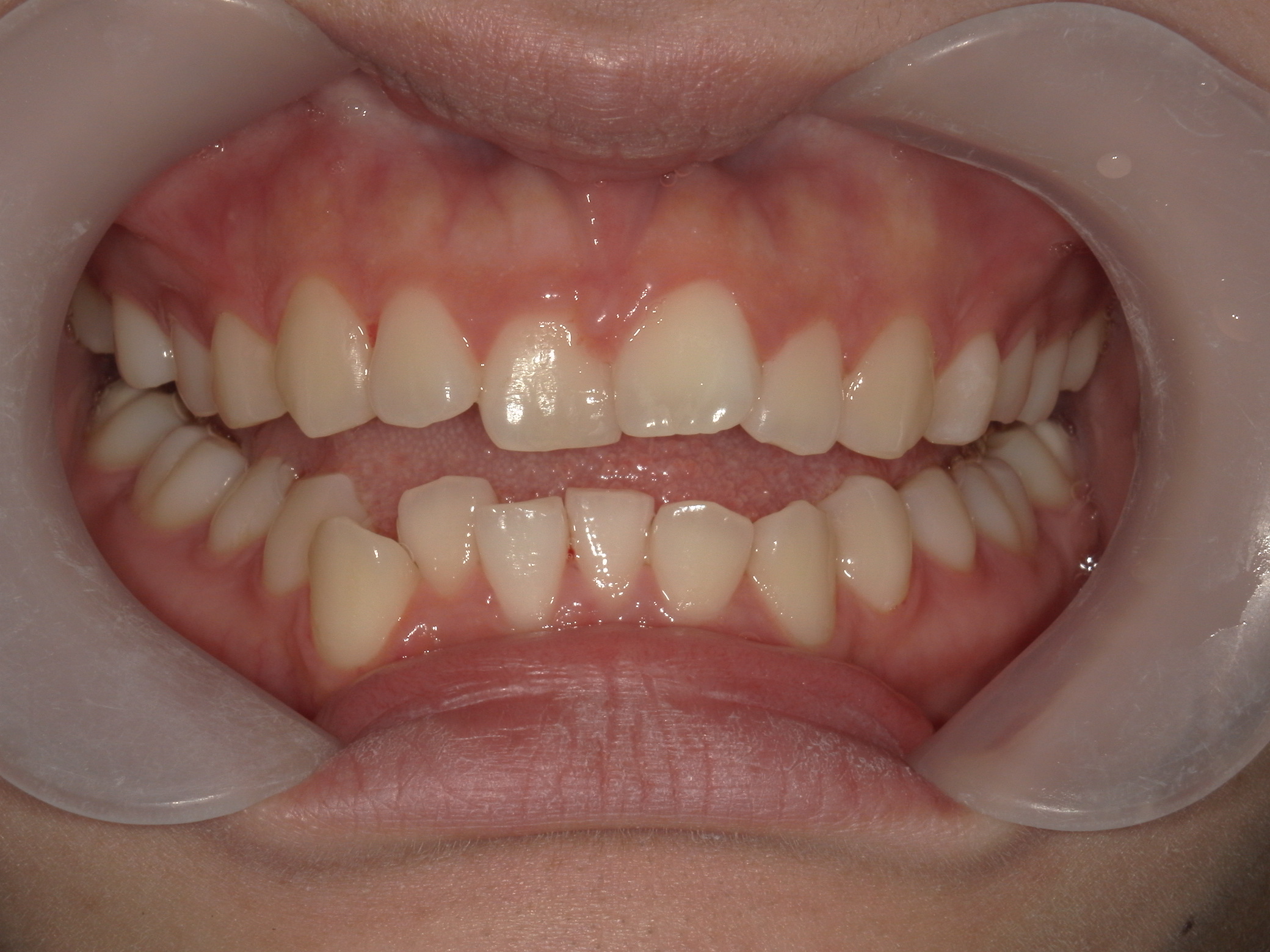 プチワイヤー矯正　症例（64）