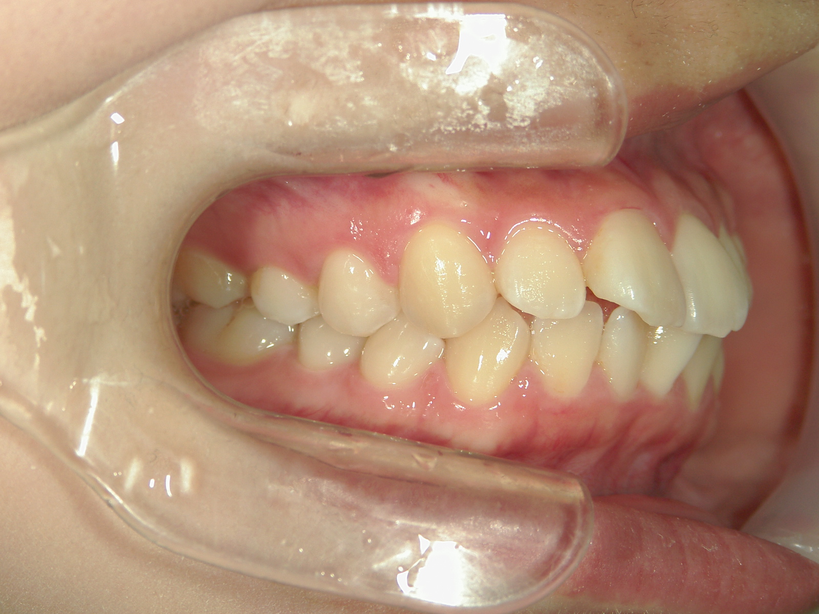 全顎ワイヤー矯正　症例（85）