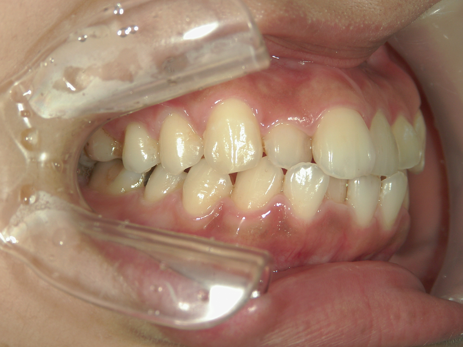 プチワイヤー矯正　症例（65）