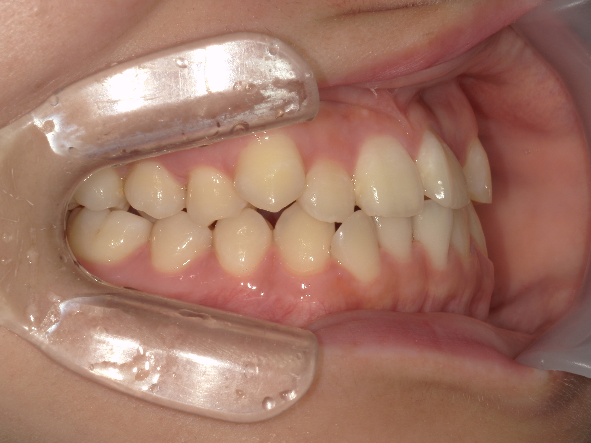 プチワイヤー矯正　症例（66）