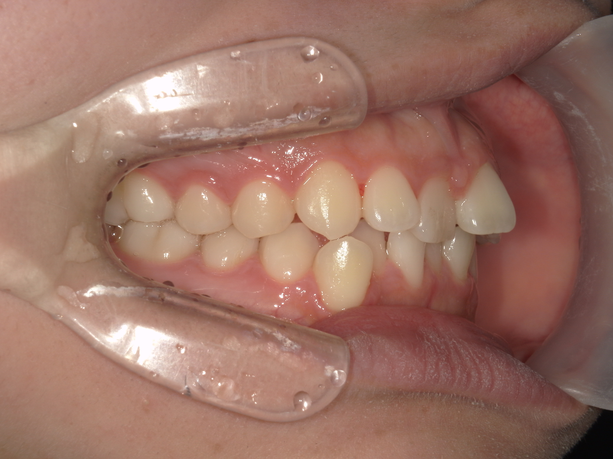 プチワイヤー矯正　症例（64）