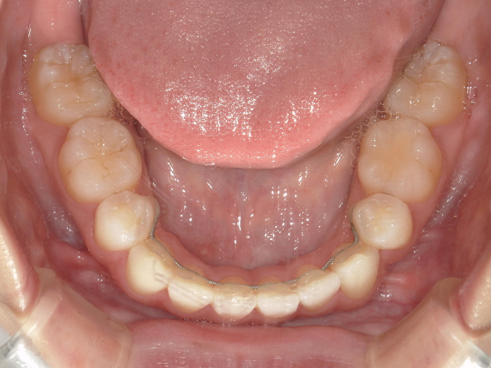 全顎ワイヤー矯正　症例（85）