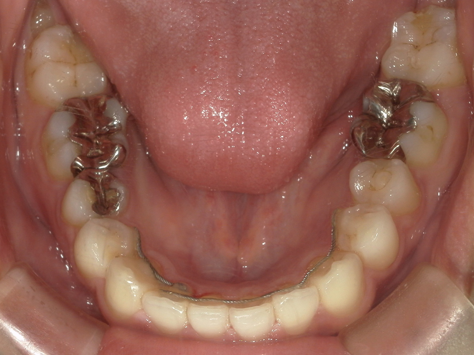 プチワイヤー矯正　症例（65）