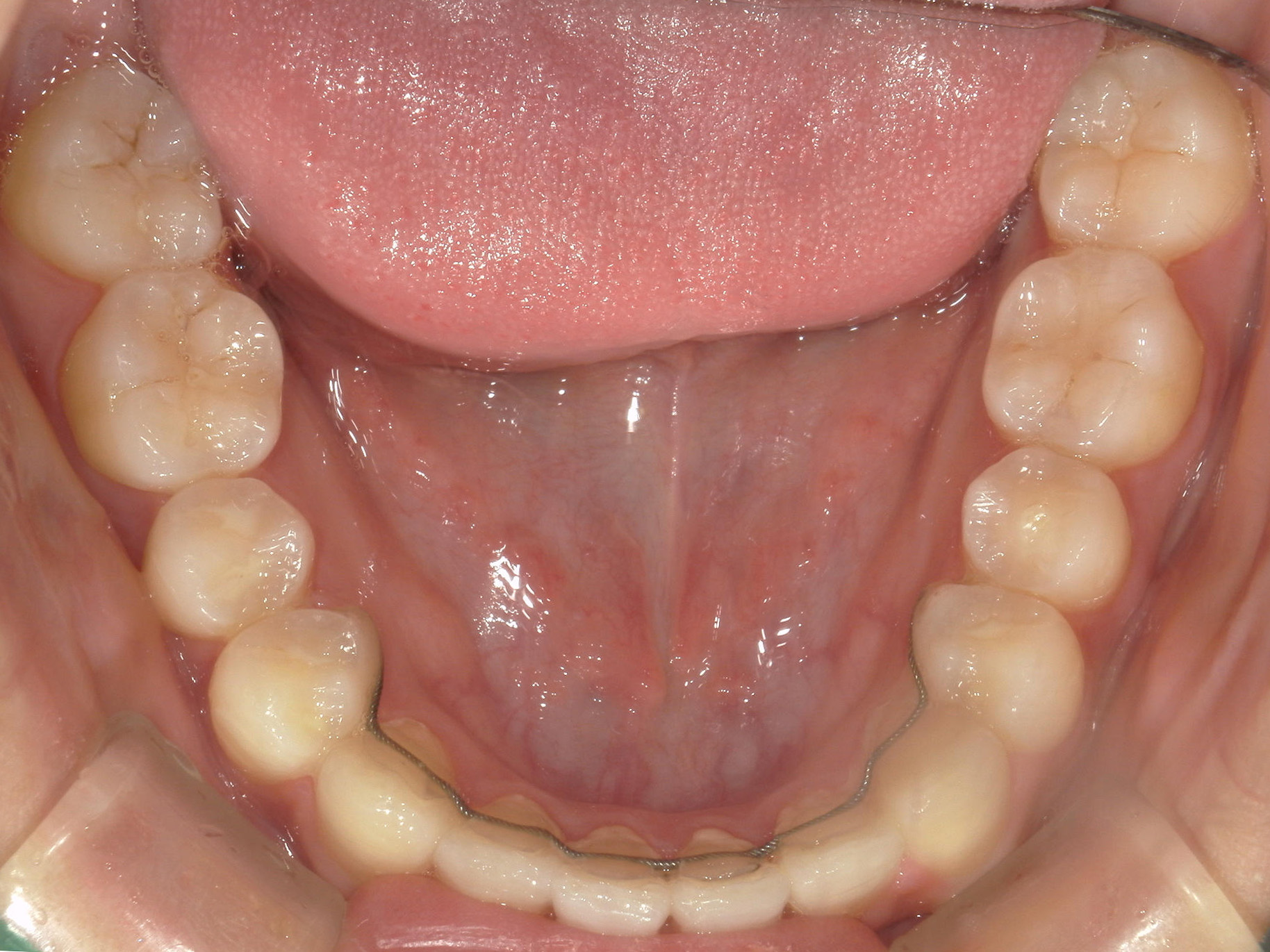 プチワイヤー矯正　症例（66）