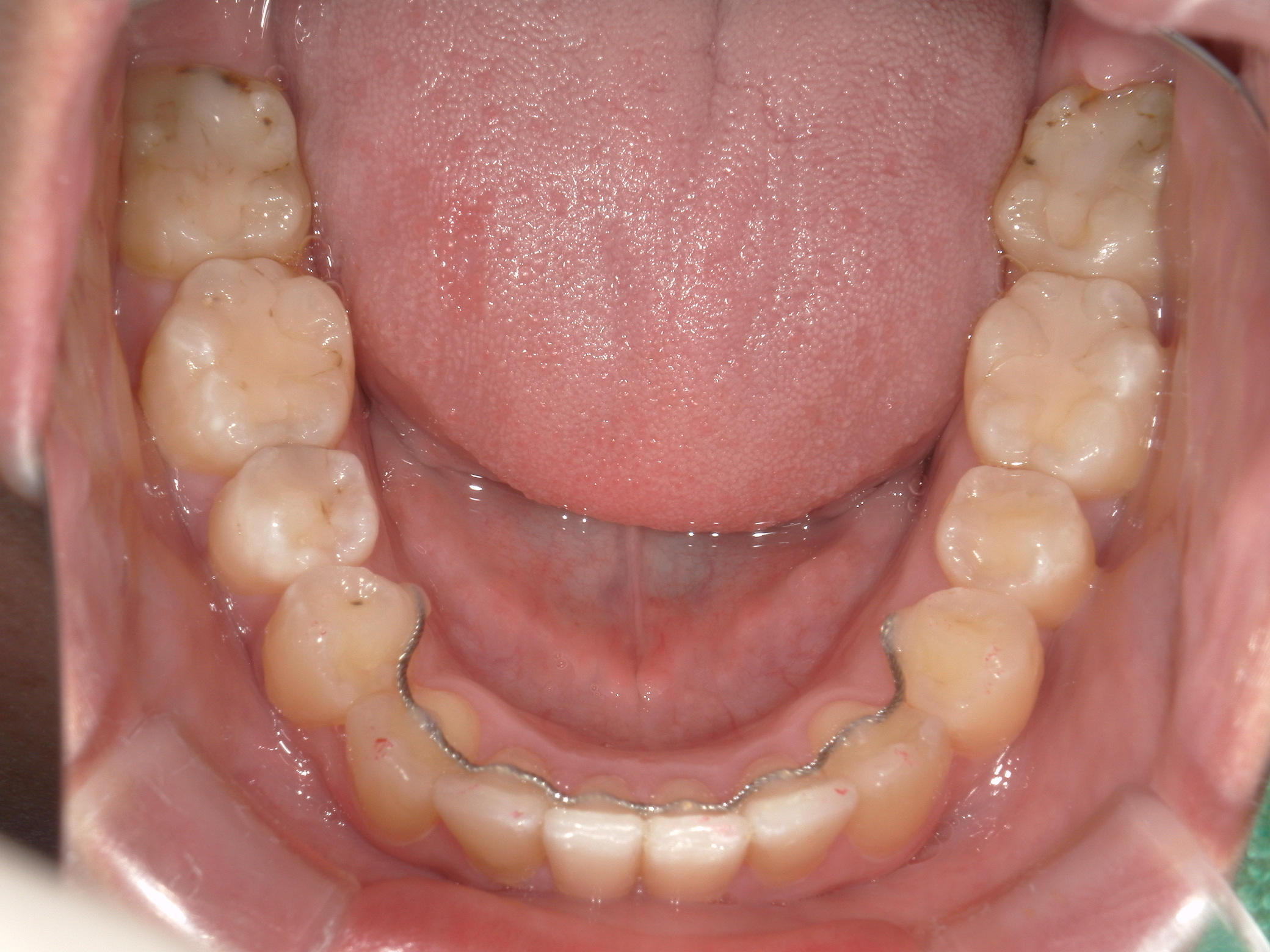 インビザライン(ライト)矯正　症例（35）