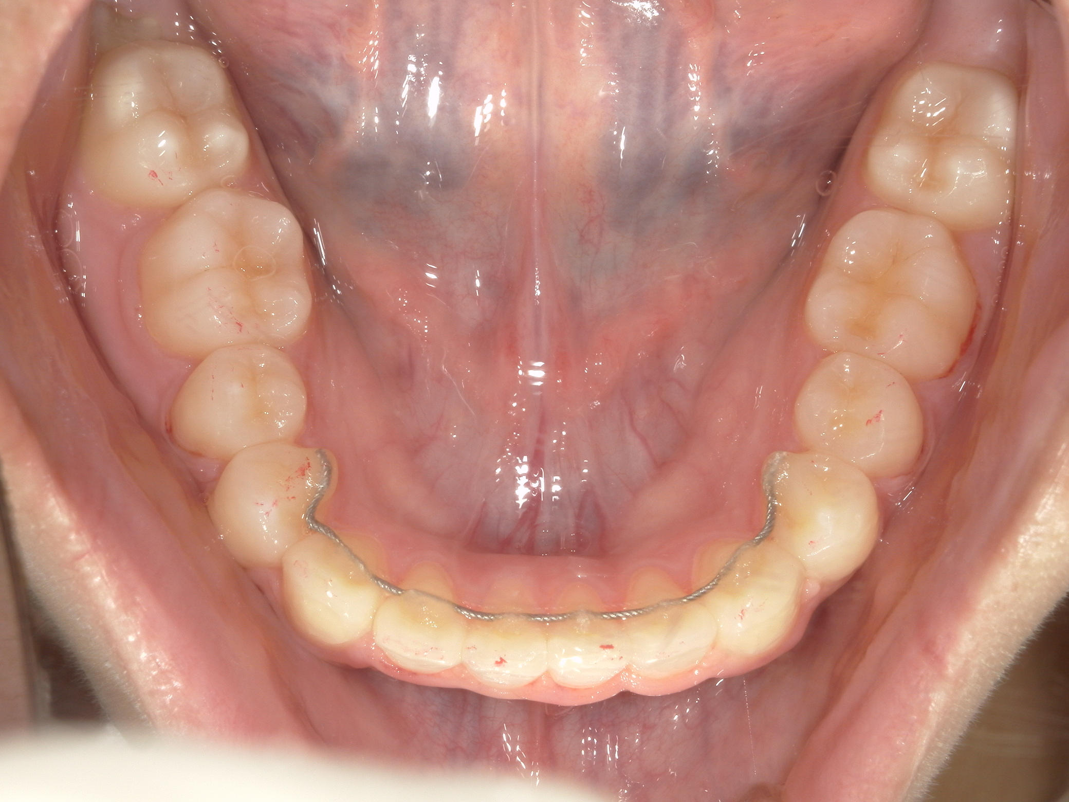 プチワイヤー矯正　症例（64）