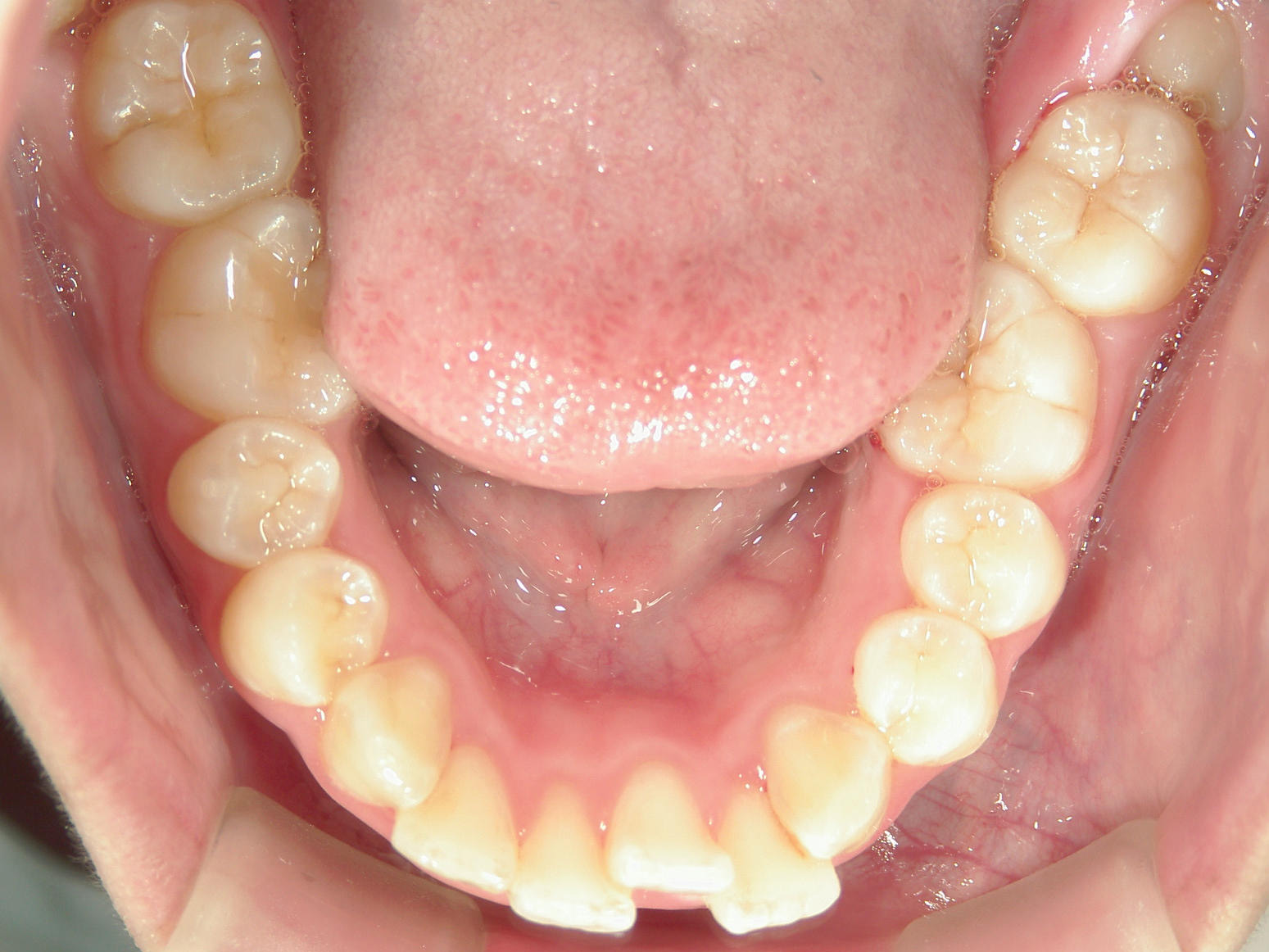舌側ワイヤー矯正　症例（32）