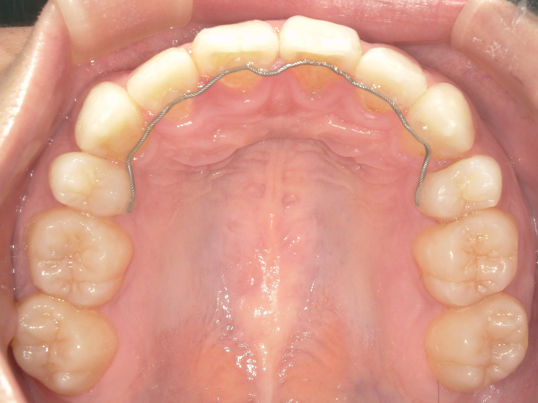 全顎ワイヤー矯正　症例（103）