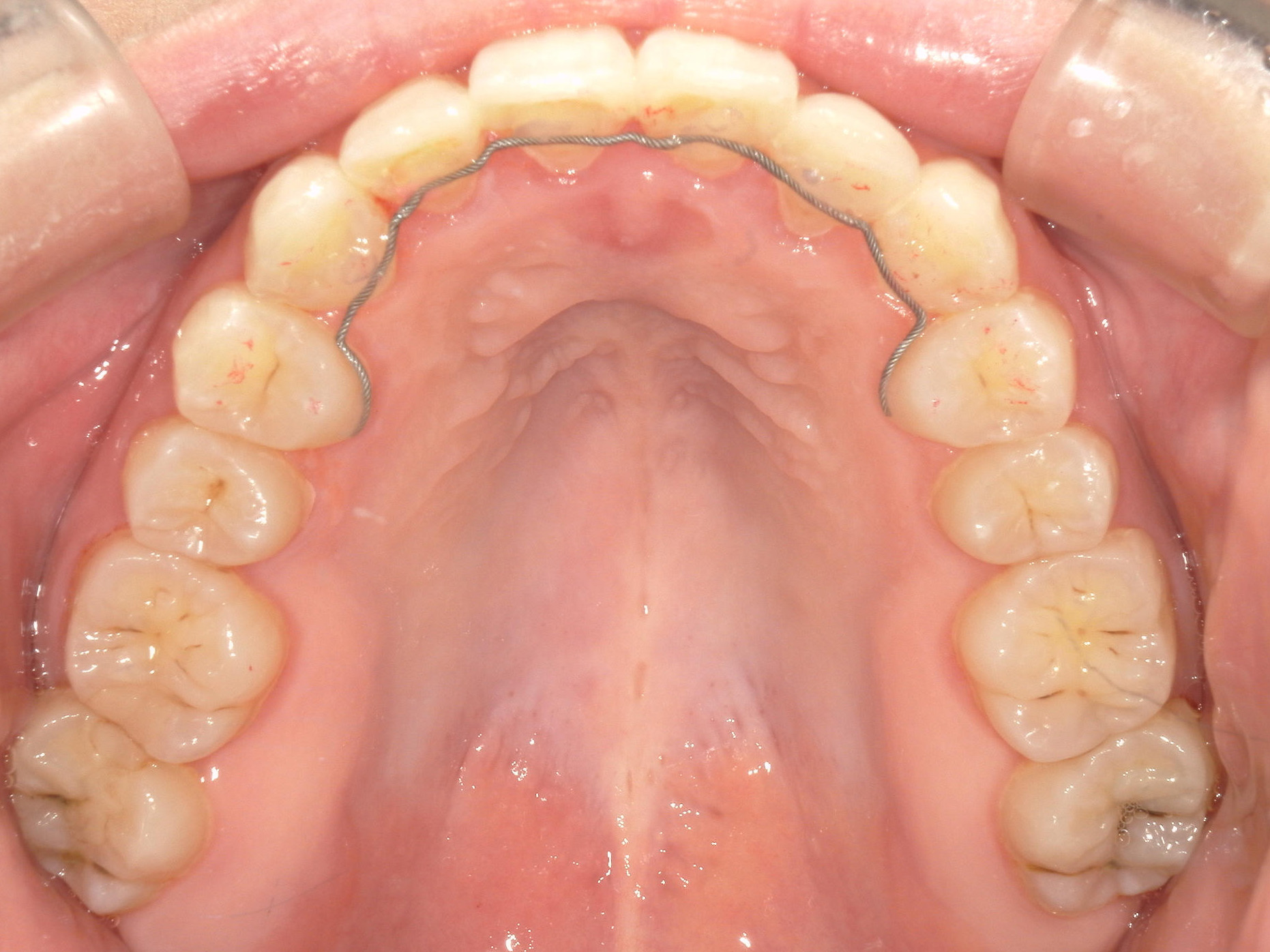 インビザライン矯正　症例（50）