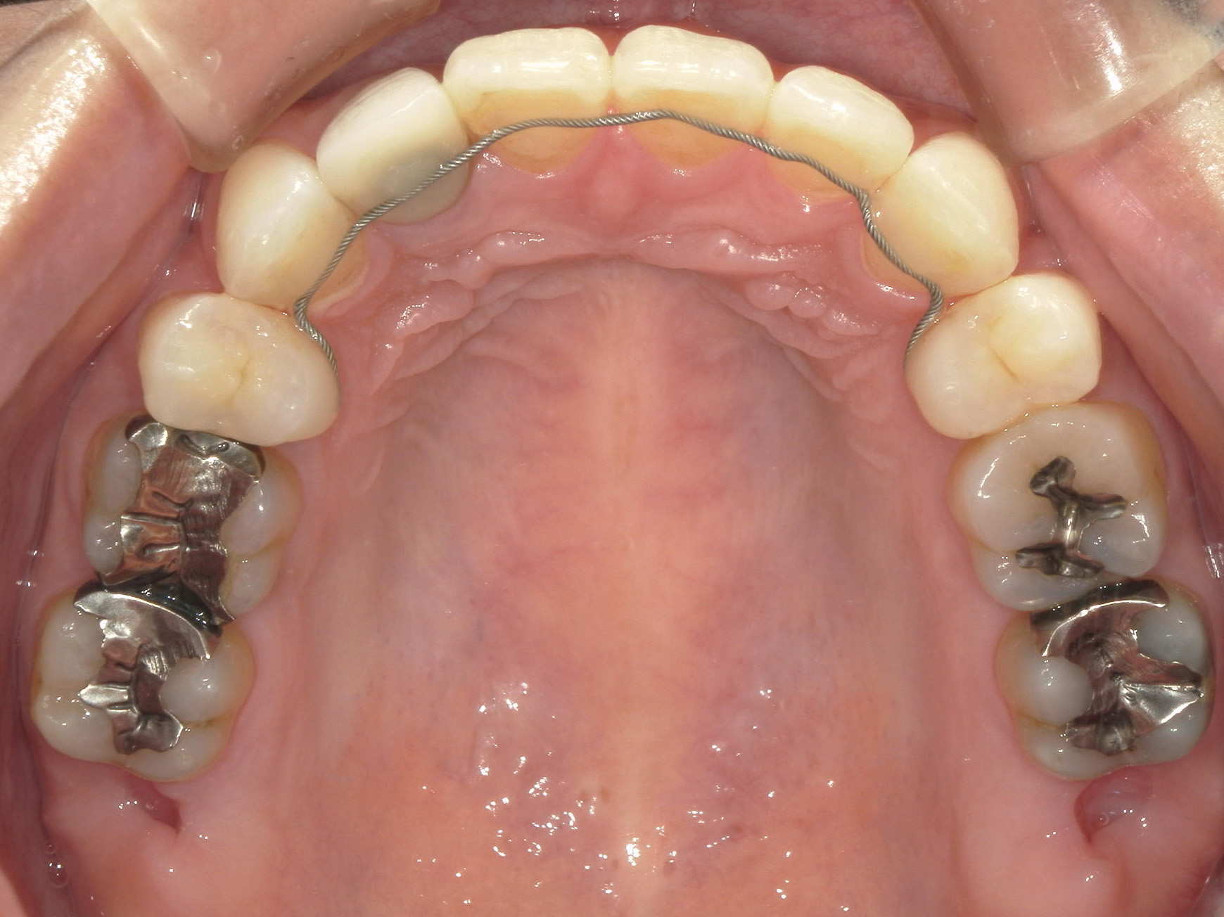 全顎ワイヤー矯正　症例（102）