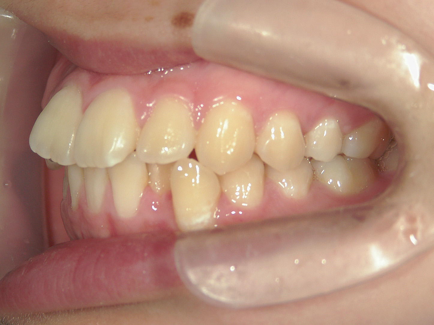 全顎ワイヤー矯正　症例（103）