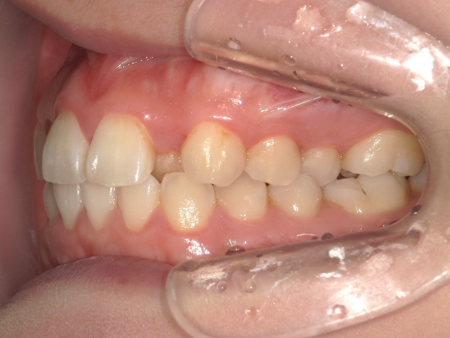 インビザライン矯正　症例（50）