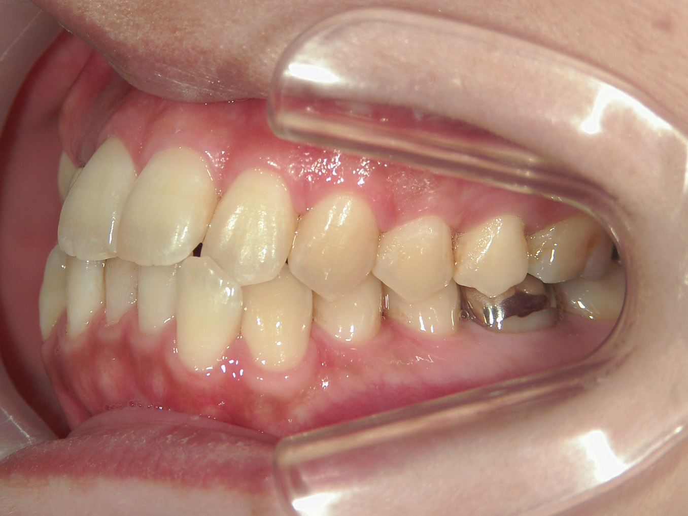 全顎ワイヤー矯正　症例（102）