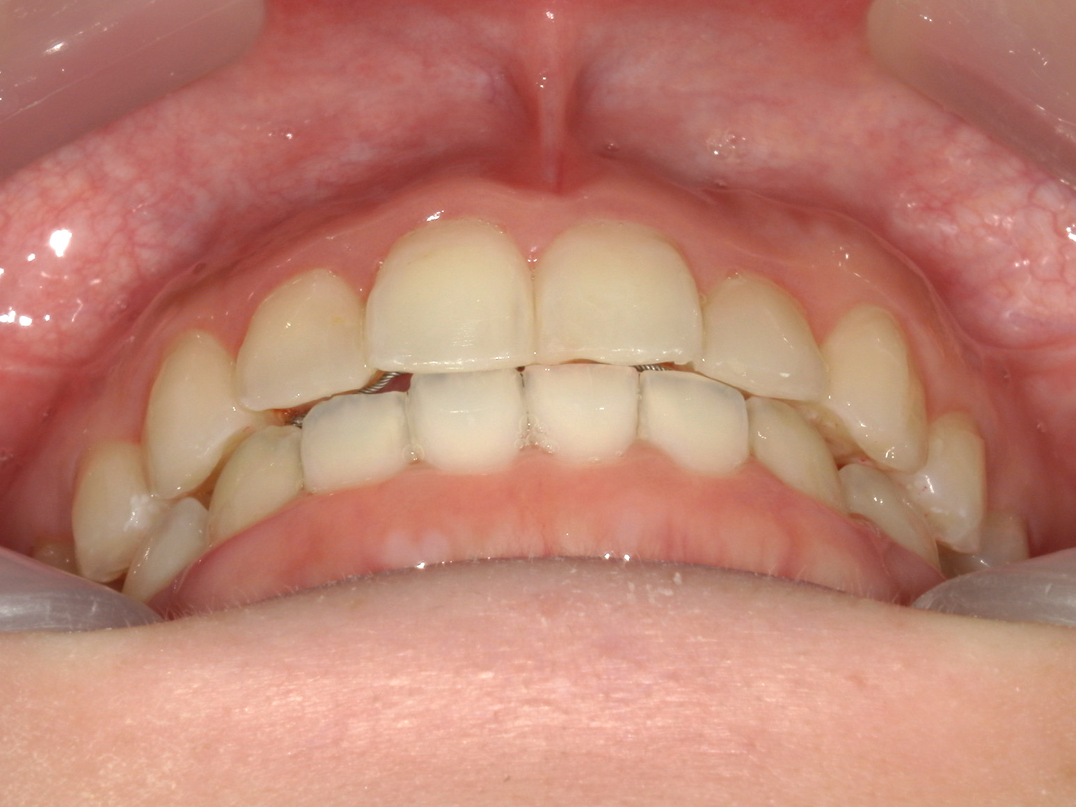 インビザライン矯正　症例（50）