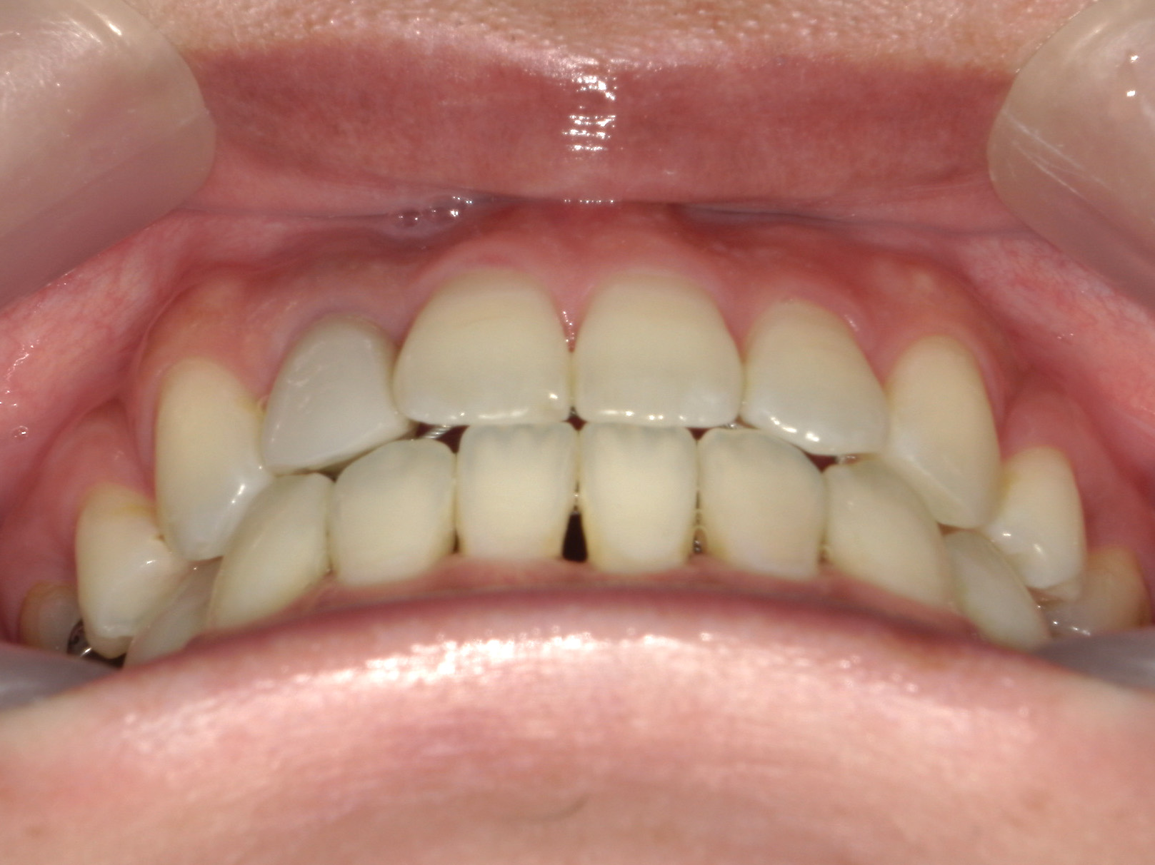 全顎ワイヤー矯正　症例（102）