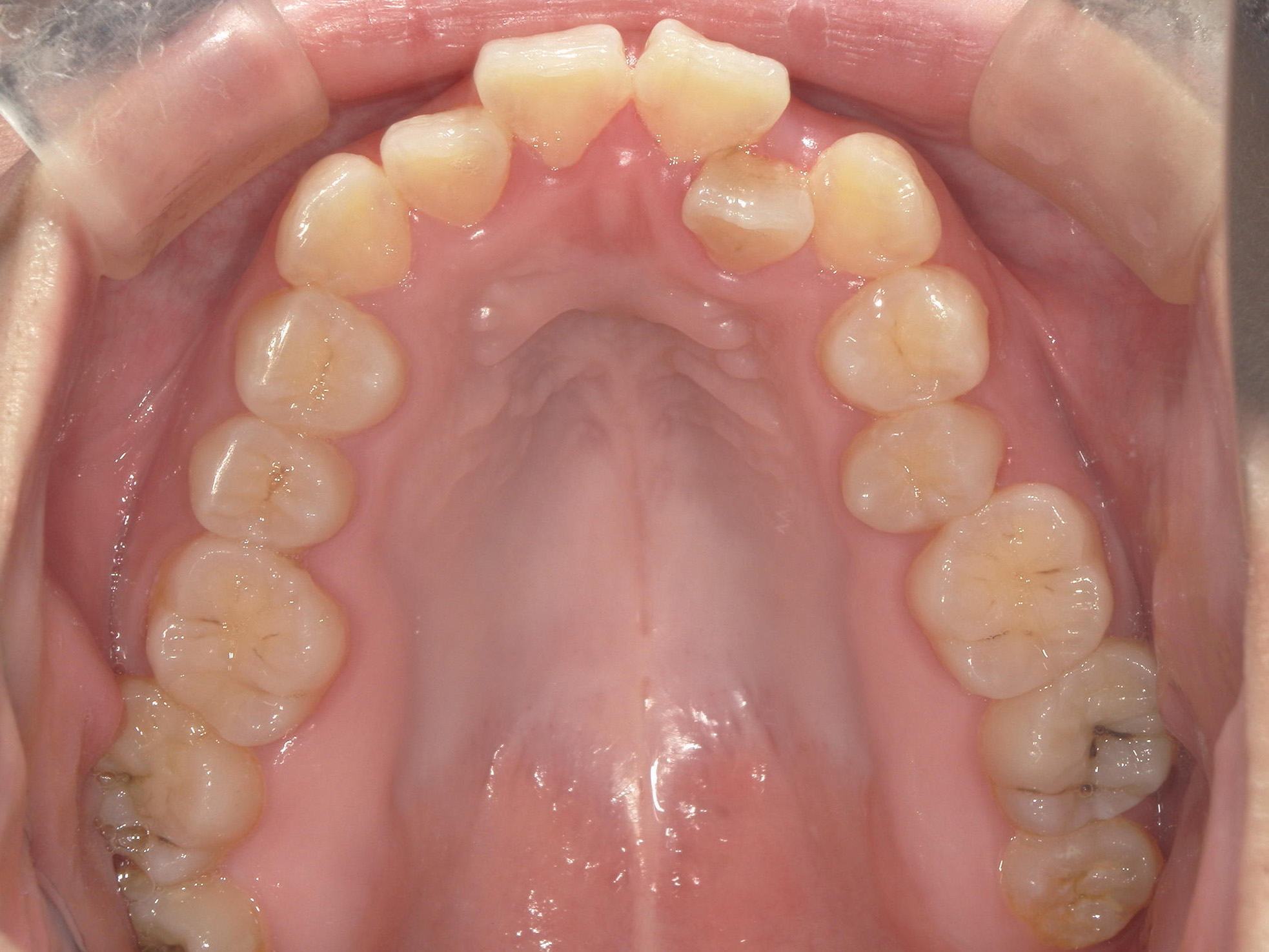 インビザライン矯正　症例（50）