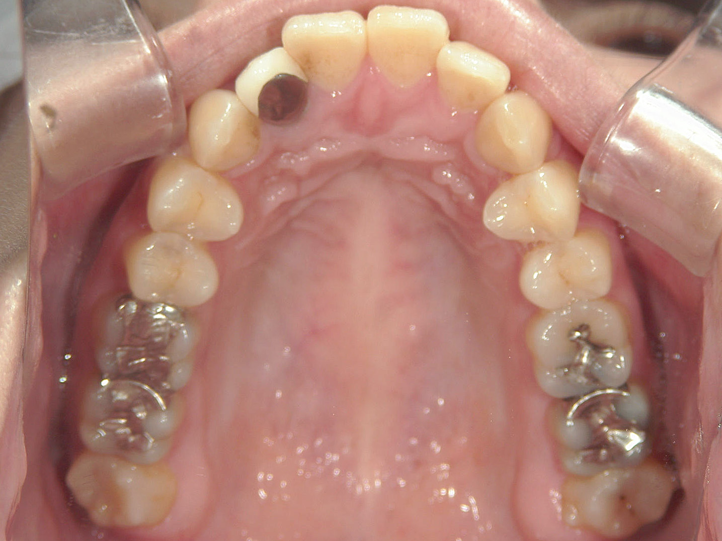 全顎ワイヤー矯正　症例（102）