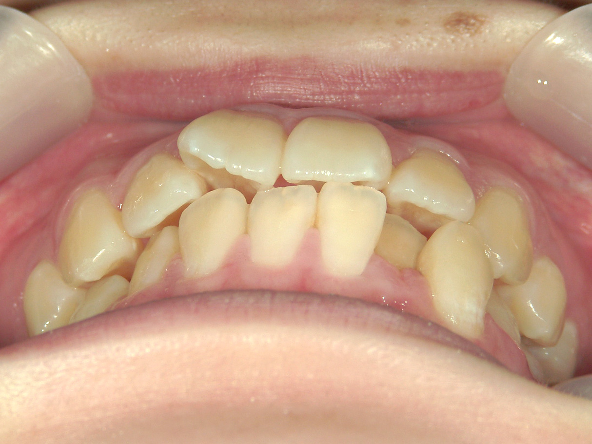 全顎ワイヤー矯正　症例（103）