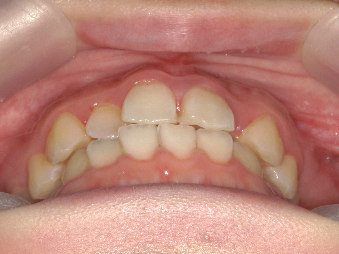 インビザライン矯正　症例（50）