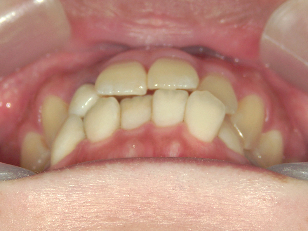 全顎ワイヤー矯正　症例（102）