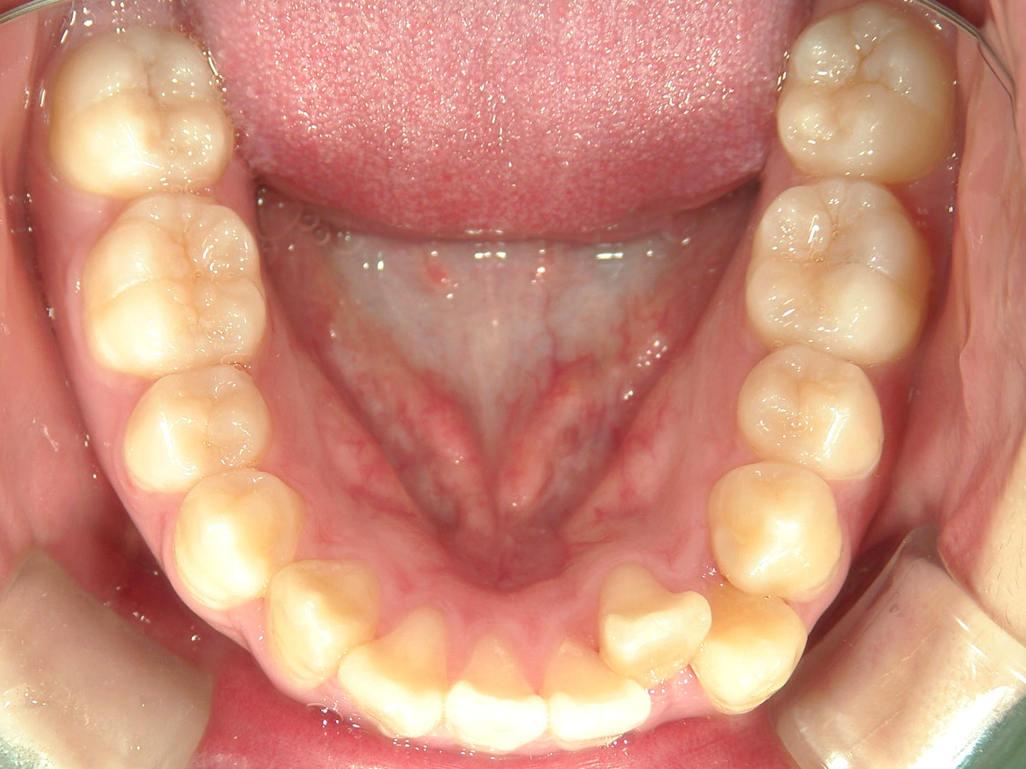 全顎ワイヤー矯正　症例（103）