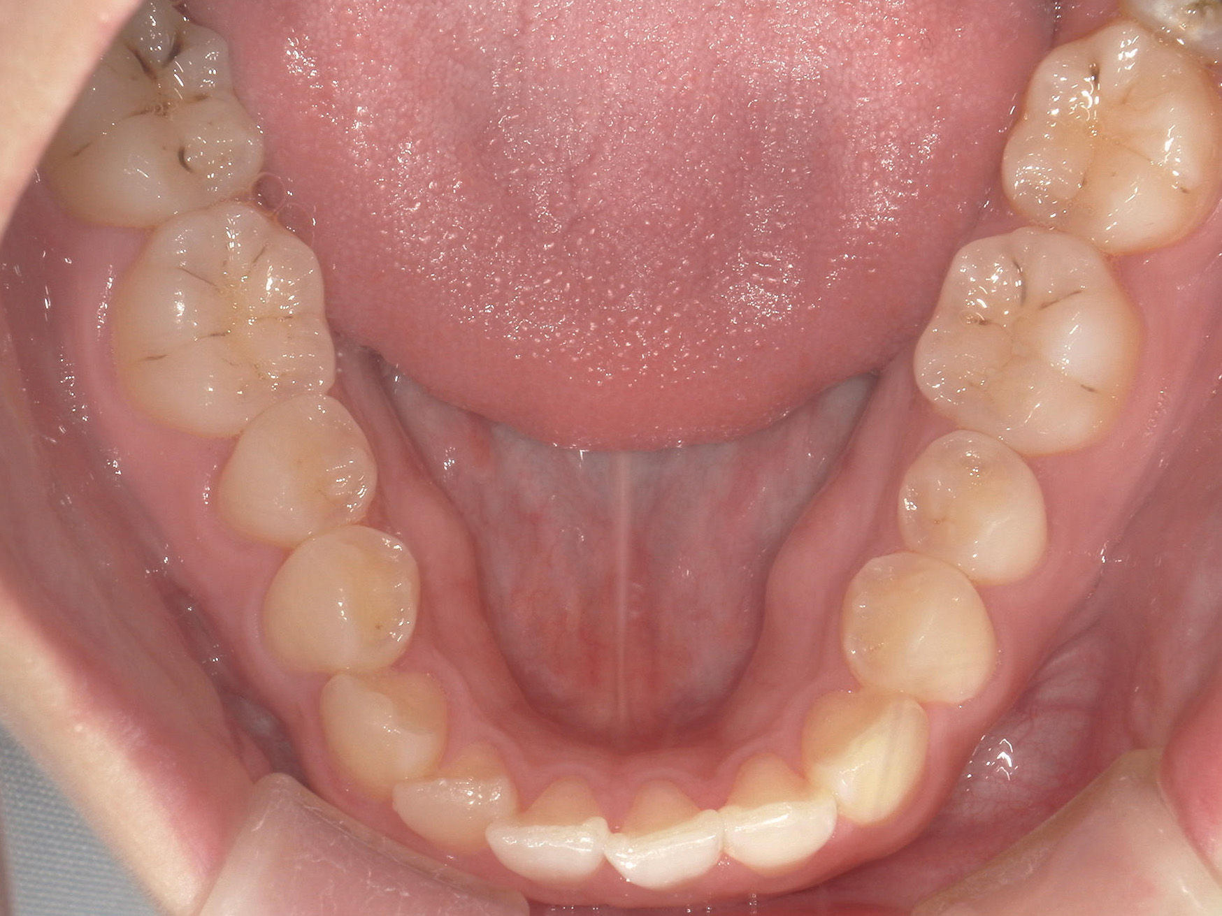 インビザライン矯正　症例（50）