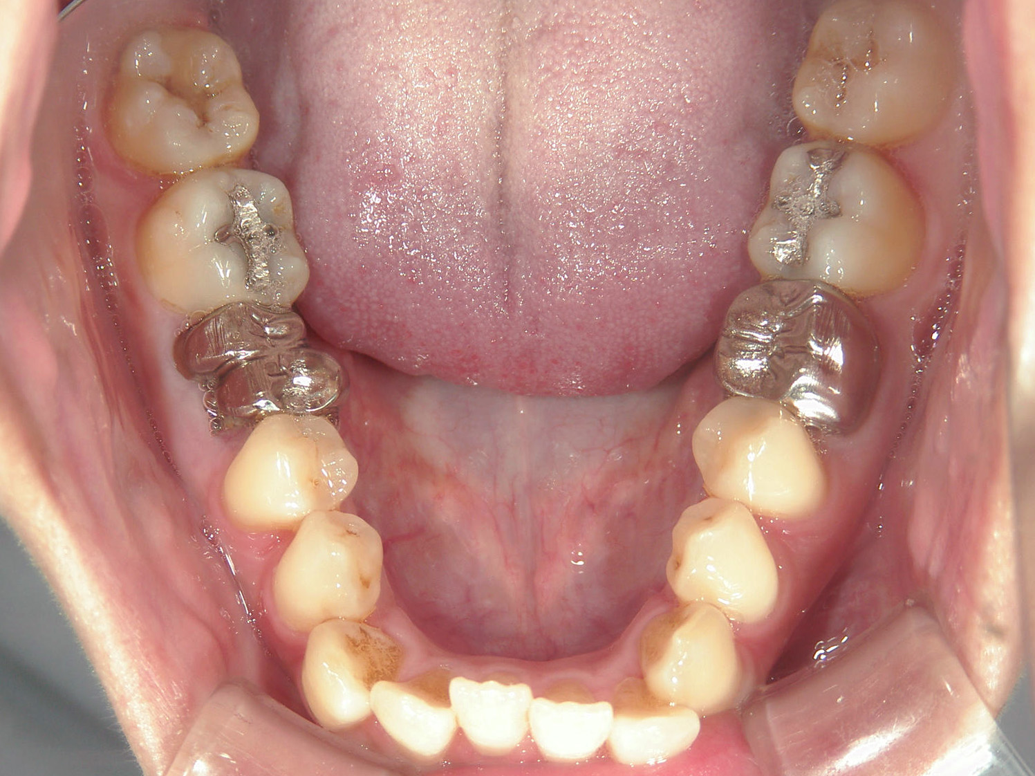 全顎ワイヤー矯正　症例（102）