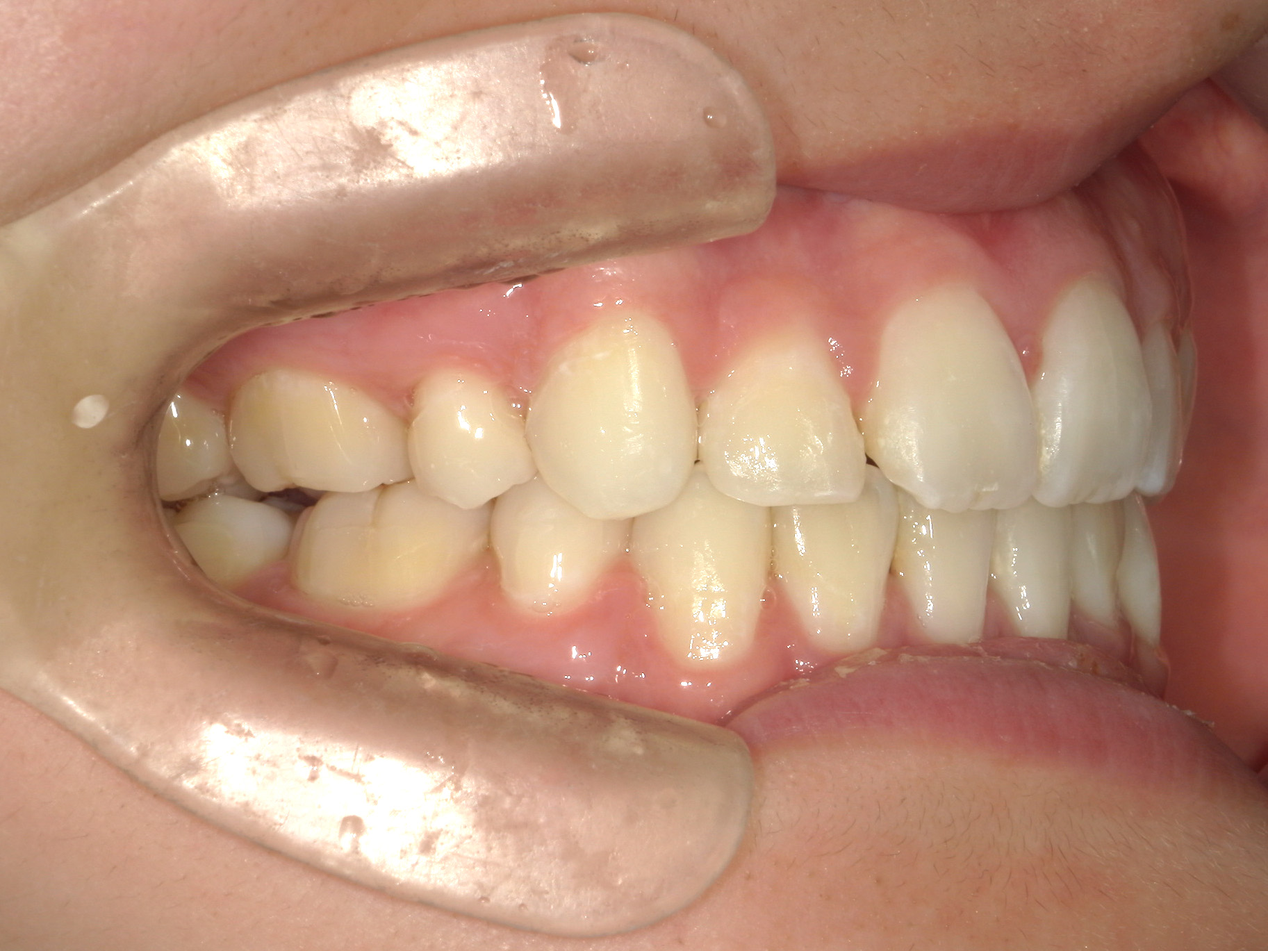 全顎ワイヤー矯正　症例（103）