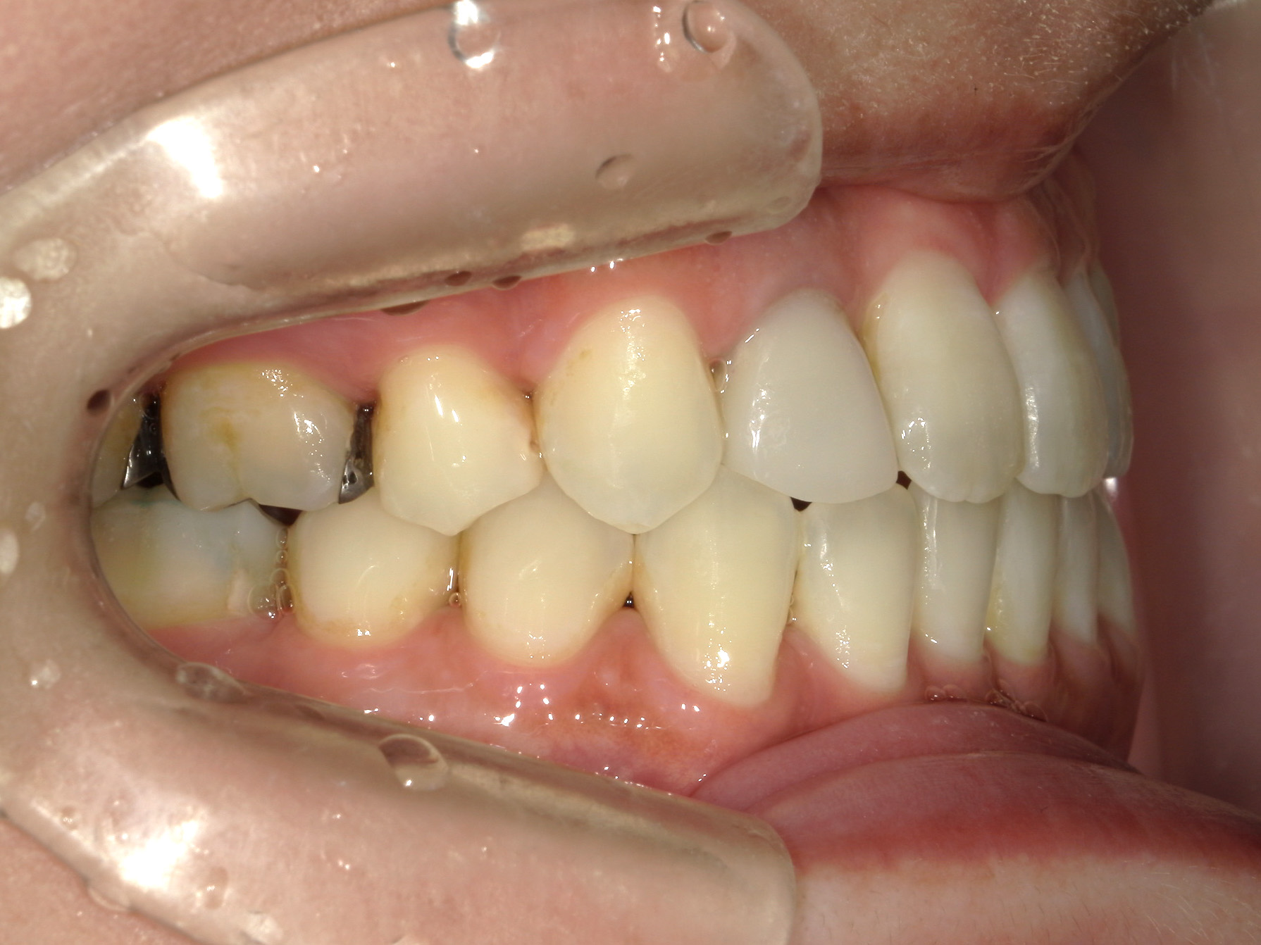 全顎ワイヤー矯正　症例（102）