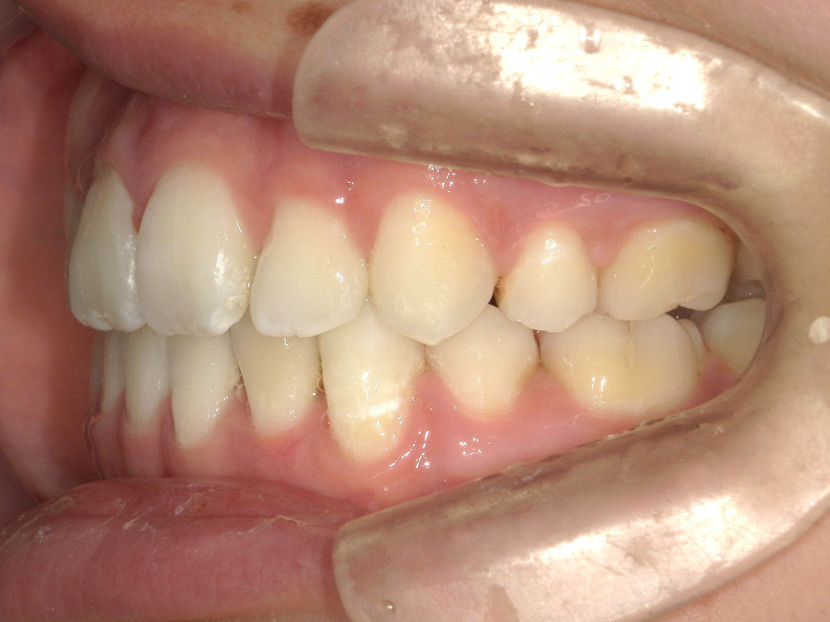 全顎ワイヤー矯正　症例（103）