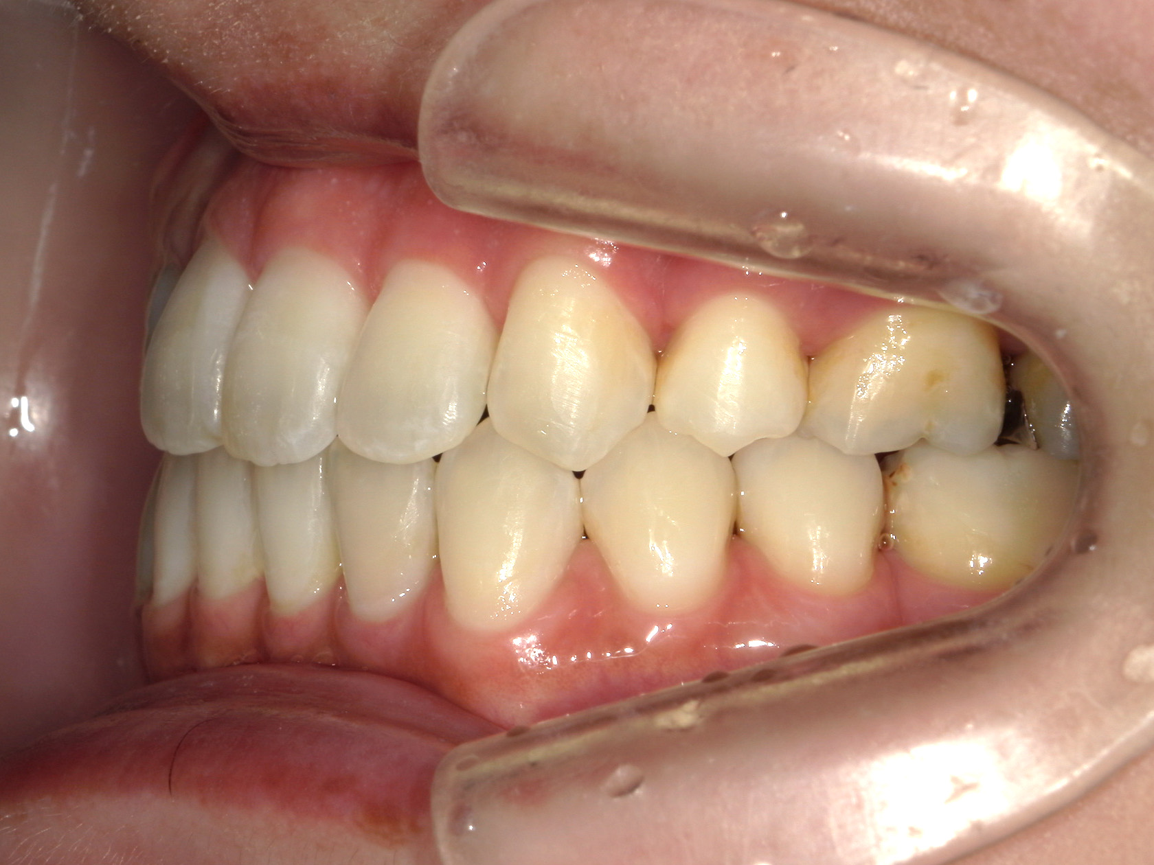 全顎ワイヤー矯正　症例（102）