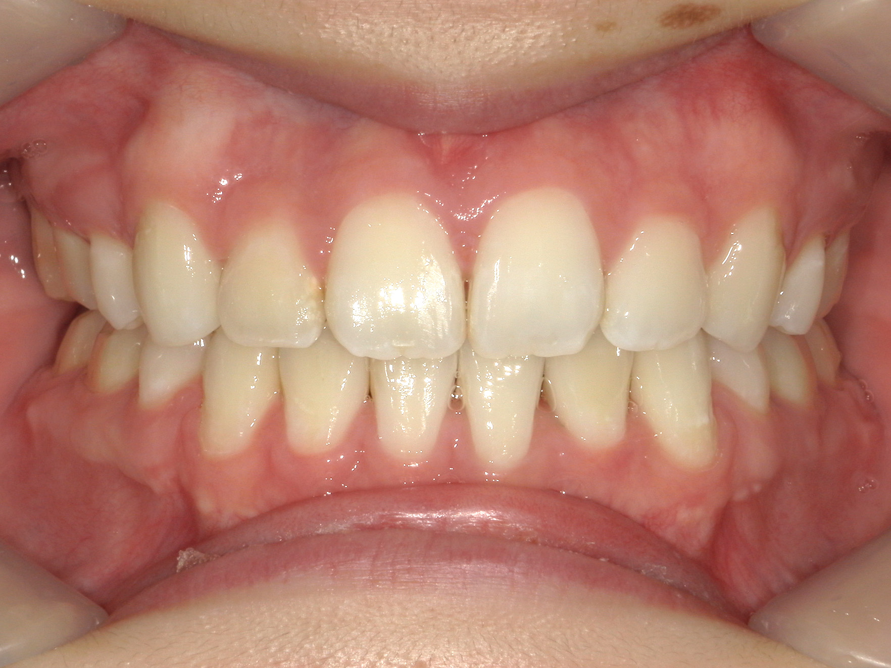 全顎ワイヤー矯正　症例（103）