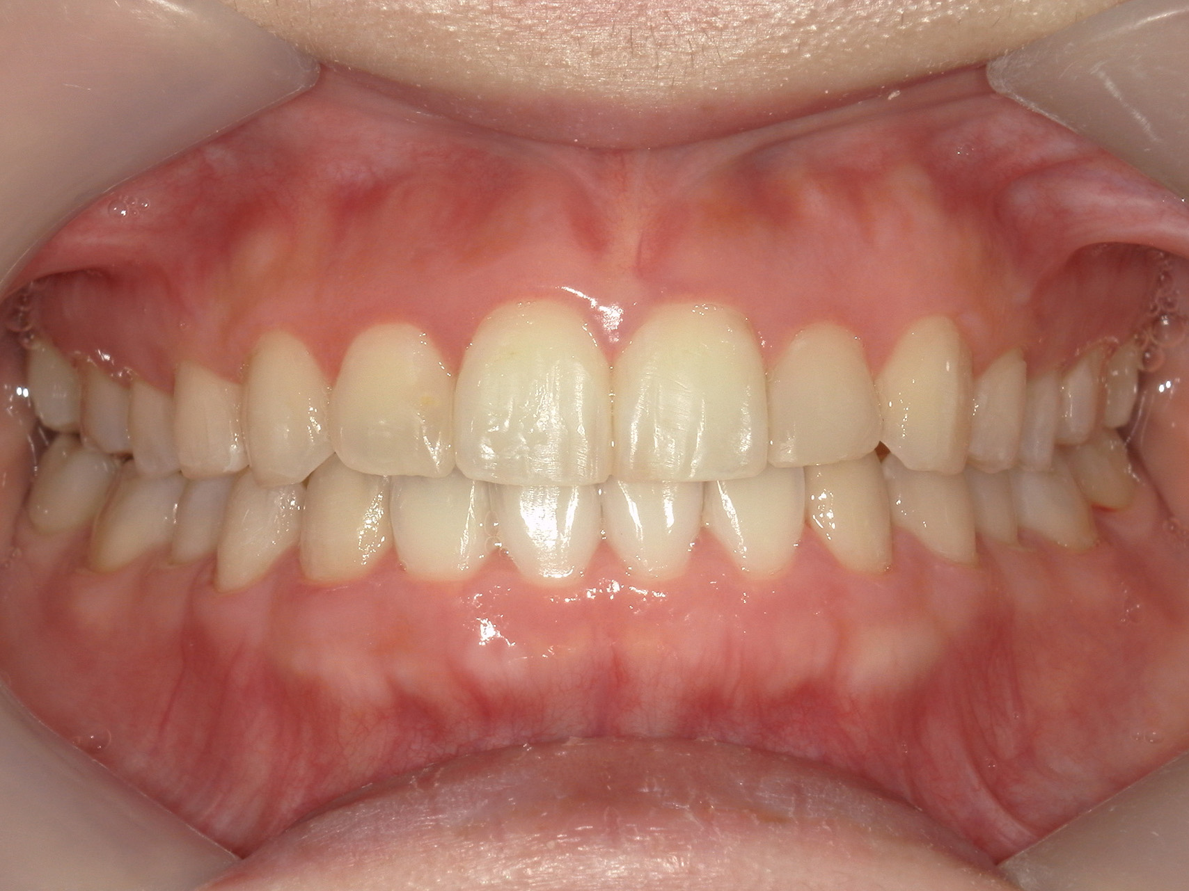 インビザライン矯正　症例（50）