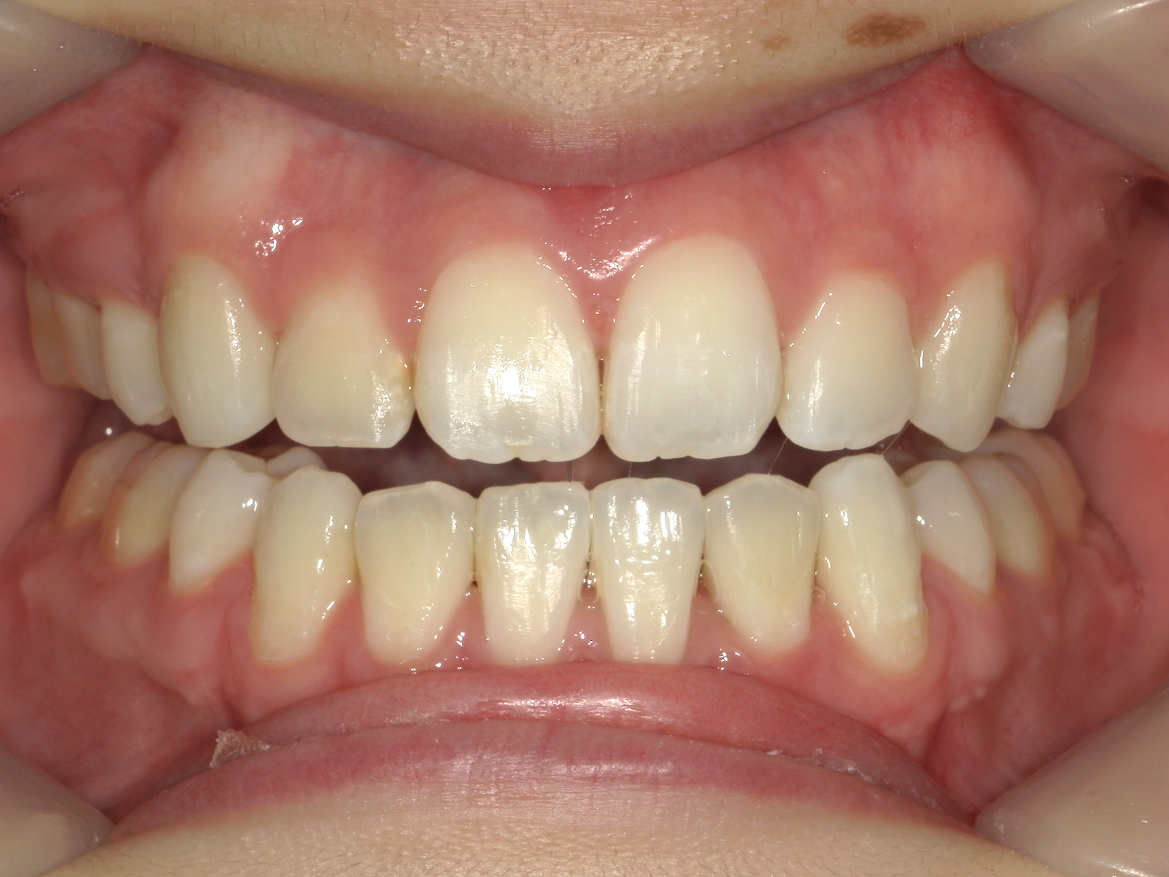 全顎ワイヤー矯正　症例（103）