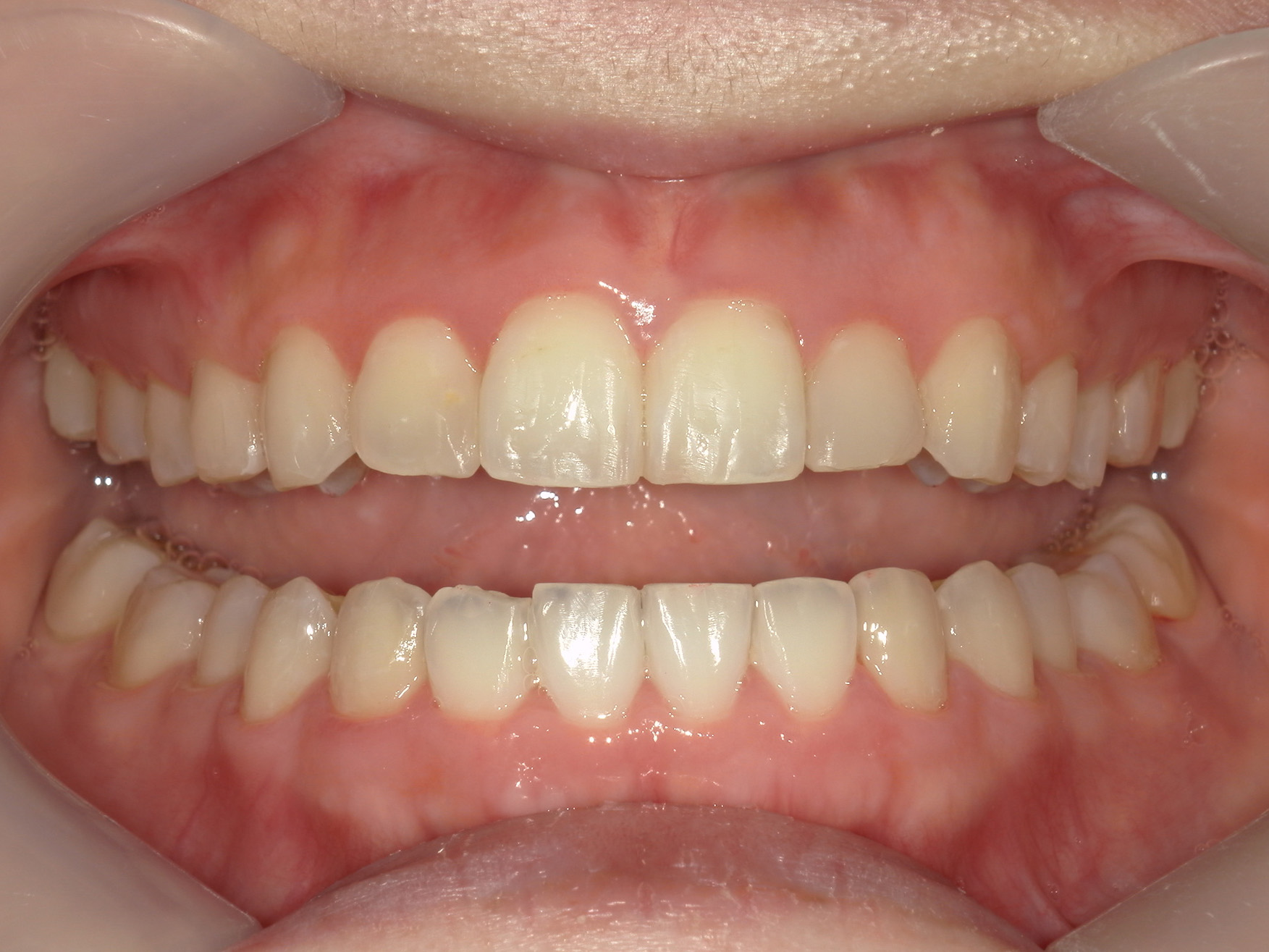 インビザライン矯正　症例（50）