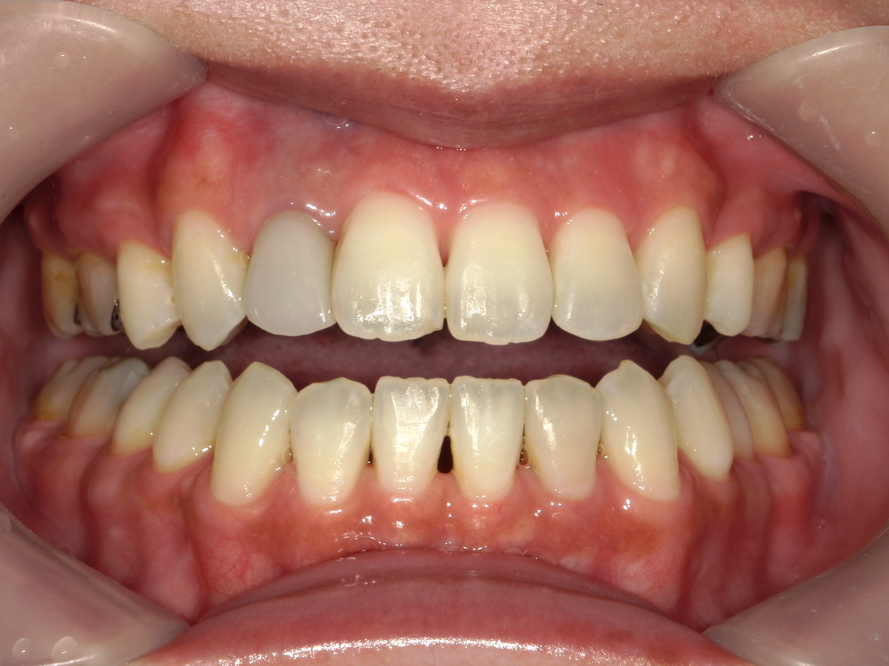 全顎ワイヤー矯正　症例（102）