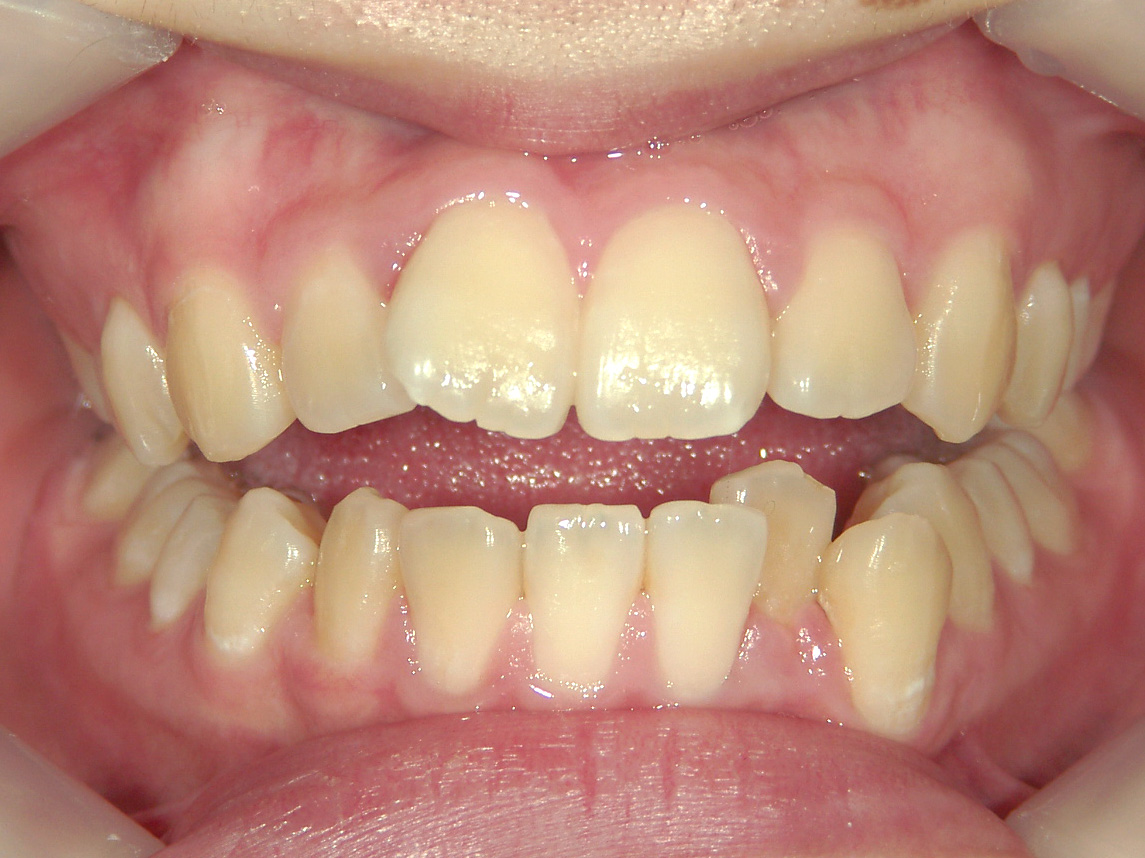 全顎ワイヤー矯正　症例（103）