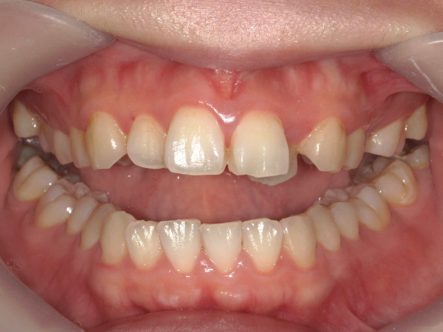 インビザライン矯正　症例（50）